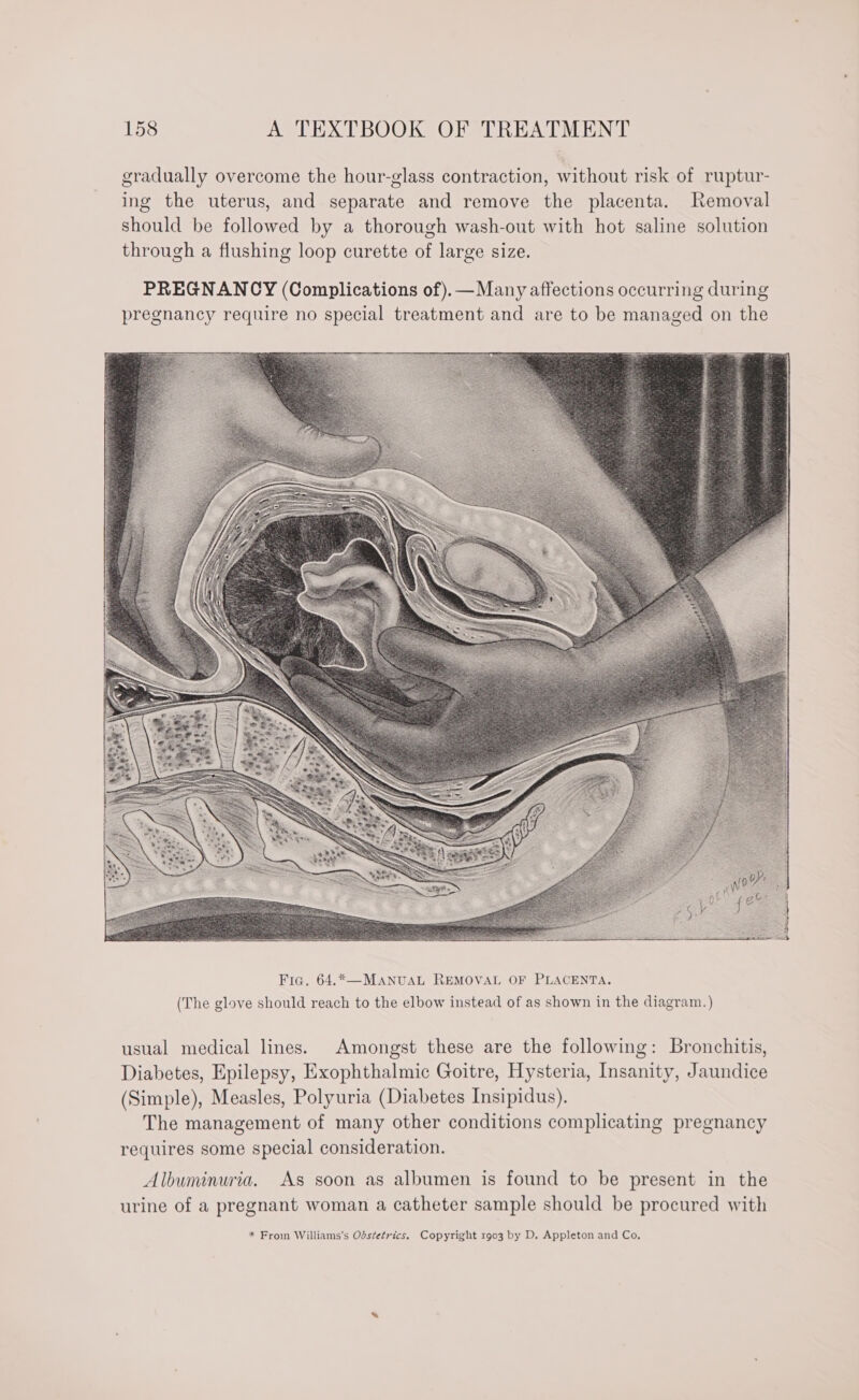 gradually overcome the hour-glass contraction, without risk of ruptur- ing the uterus, and separate and remove the placenta. Removal should be followed by a thorough wash-out with hot saline solution through a flushing loop curette of large size. Fia. 64.*—MANUAL REMOVAL OF PLACENTA. (The glove should reach to the elbow instead of as shown in the diagram.) usual medical lines. Amongst these are the following: Bronchitis, Diabetes, Epilepsy, Exophthalmic Goitre, Hysteria, Insanity, Jaundice (Simple), Measles, Polyuria (Diabetes Insipidus). The management of many other conditions complicating pregnancy requires some special consideration. Albuminuria, As soon as albumen is found to be present in the urine of a pregnant woman a catheter sample should be procured with * Froin Williams's Obstetrics. Copyright 1903 by D. Appleton and Co,