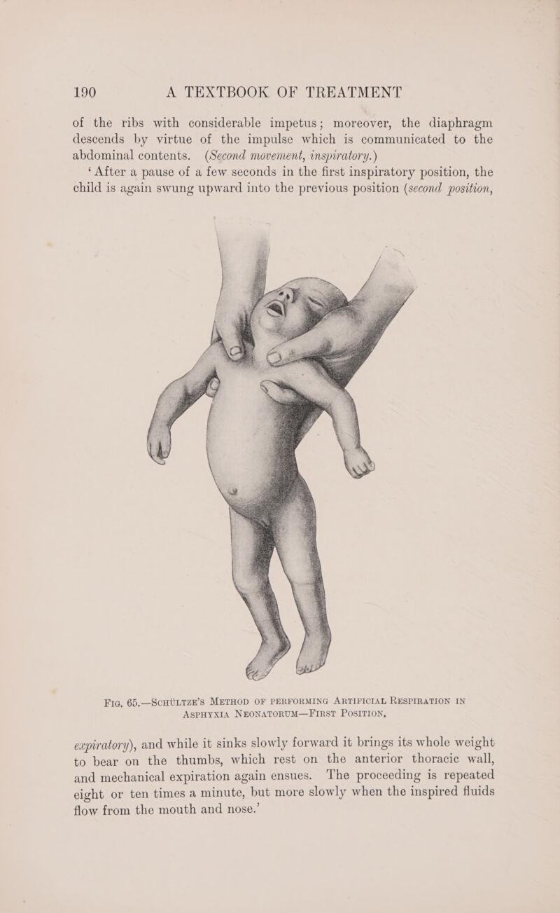 of the ribs with considerable impetus; moreover, the diaphragm descends by virtue of the impulse which is communicated to the abdominal contents. (Second movement, inspiratory. ) ‘After a pause of a few seconds in the first inspiratory position, the child is again swung upward into the previous position (second position, Fia. 65,—SCHULTZE’S METHOD OF PERFORMING ARTIFICIAL RESPIRATION IN ASPHYXIA NEONATORUM—FIRST POSITION, expiratory), and while it sinks slowly forward it brings its whole weight to bear on the thumbs, which rest on the anterior thoracic wall, and mechanical expiration again ensues. The proceeding is repeated eight or ten times a minute, but more slowly when the inspired fluids flow from the mouth and nose.’