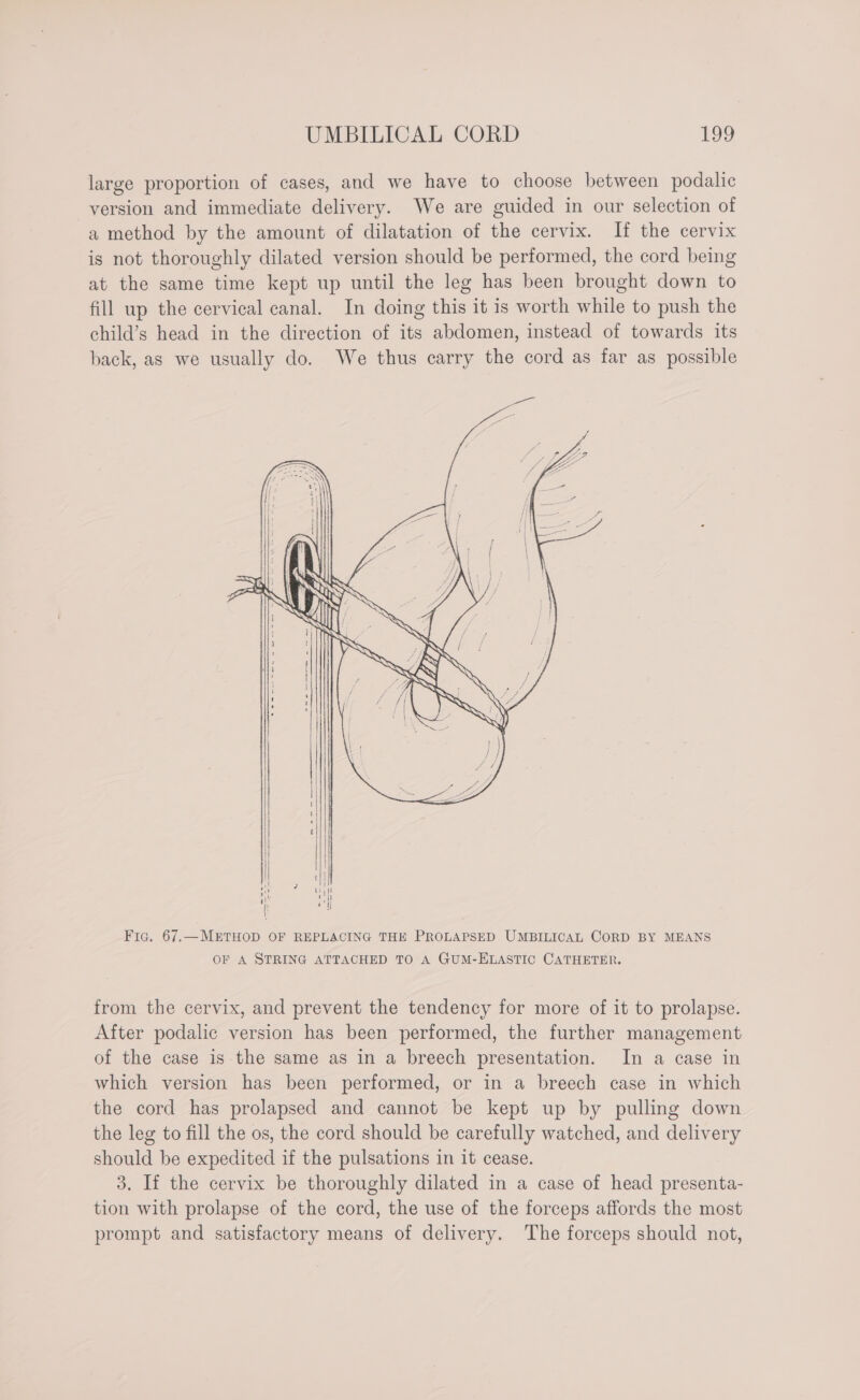 UMBILICAL CORD Hs, large proportion of cases, and we have to choose between podalic version and immediate delivery. We are guided in our selection of a method by the amount of dilatation of the cervix. If the cervix is not thoroughly dilated version should be performed, the cord being at the same time kept up until the leg has been brought down to fill up the cervical canal. In doing this it is worth while to push the child’s head in the direction of its abdomen, instead of towards its back, as we usually do. We thus carry the cord as far as possible ite ) i Fic. 67.—METHOD OF REPLACING THE PROLAPSED UMBILICAL CORD BY MEANS OF A STRING ATTACHED TO A GUM-ELASTIC CATHETER. from the cervix, and prevent the tendency for more of it to prolapse. After podalic version has been performed, the further management of the case is the same as in a breech presentation. In a case in which version has been performed, or in a breech case in which the cord has prolapsed and cannot be kept up by pulling down the leg to fill the os, the cord should be carefully watched, and delivery should be expedited if the pulsations in it cease. 3. If the cervix be thoroughly dilated in a case of head presenta- tion with prolapse of the cord, the use of the forceps affords the most prompt and satisfactory means of delivery. The forceps should not,