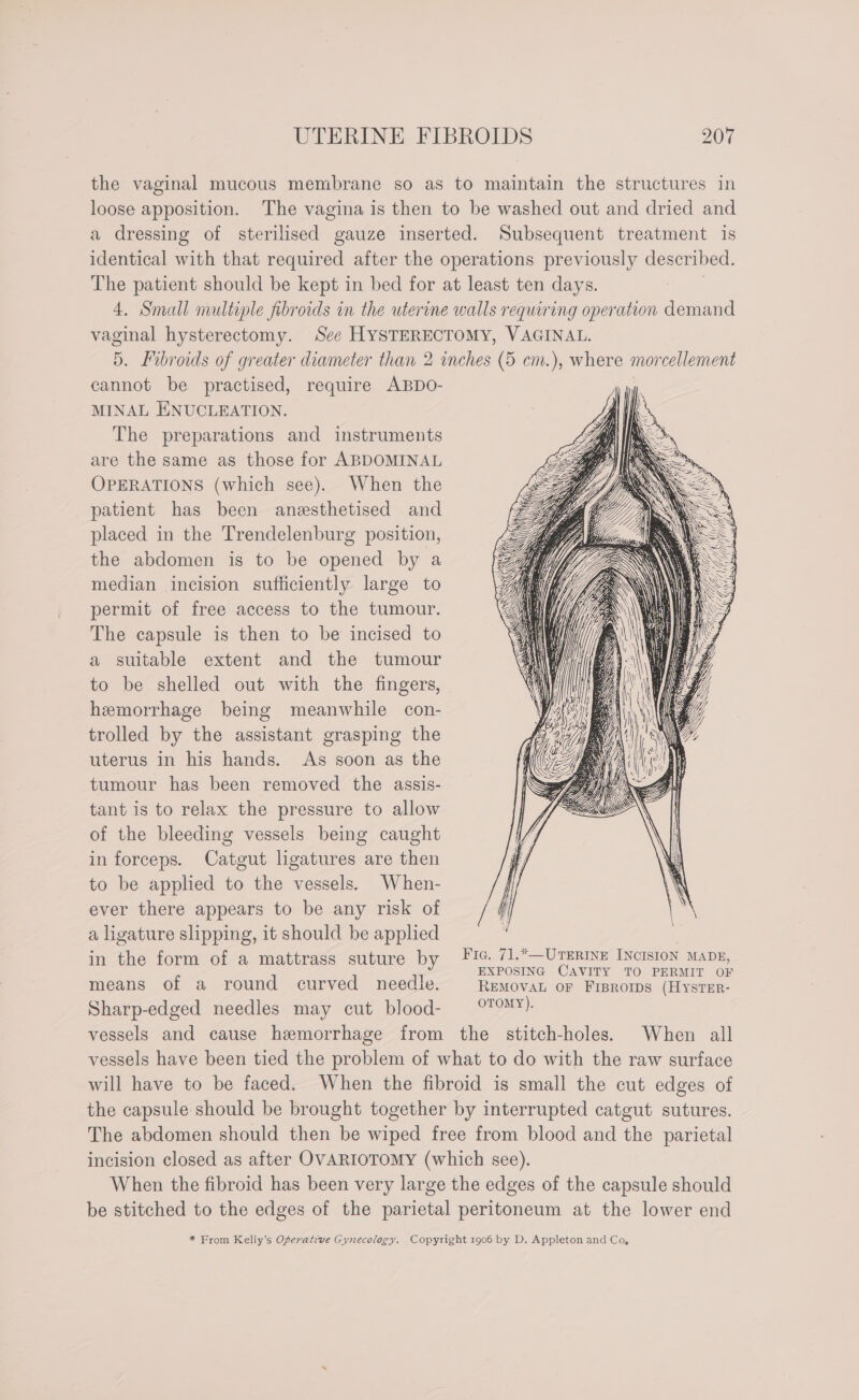 the vaginal mucous membrane so as to maintain the structures in loose apposition. The vagina is then to be washed out and dried and a dressing of sterilised gauze inserted. Subsequent treatment is identical with that required after the operations previously described. The patient should be kept in bed for at least ten days. | 4. Small multiple fibroids in the uterine walls requiring operation demand vaginal hysterectomy. See HYSTERECTOMY, VAGINAL. 5. Fibroids of greater diameter than 2 inches (5 em.), where morcellement cannot be practised, require ABDO- MINAL ENUCLEATION. The preparations and instruments are the same as those for ABDOMINAL OPERATIONS (which see). When the patient has been anesthetised and placed in the Trendelenburg position, the abdomen is to be opened by a median incision sufficiently large to permit of free access to the tumour. The capsule is then to be incised to a suitable extent and the tumour to be shelled out with the fingers, hemorrhage being meanwhile con- trolled by the assistant grasping the uterus in his hands. As soon as the tumour has been removed the assis- tant is to relax the pressure to allow of the bleeding vessels being caught in forceps. Catgut ligatures are then to be applied to the vessels. When- ever there appears to be any risk of a ligature slipping, it should be applied in the form of a mattrass suture by 6. 71.*—UtsErine INciston Mans, EXPOSING CAVITY TO PERMIT OF means of a round curved needle. REMOVAL OF FIBROIDS (HyYsTER- Sharp-edged needles may cut blood- °T°™¥): vessels and cause hemorrhage from the stitch-holes. When all vessels have been tied the problem of what to do with the raw surface will have to be faced. When the fibroid is small the cut edges of the capsule should be brought together by interrupted catgut sutures. The abdomen should then be wiped free from blood and the parietal incision closed as after OVARIOTOMY (which see). When the fibroid has been very large the edges of the capsule should be stitched to the edges of the parietal peritoneum at the lower end