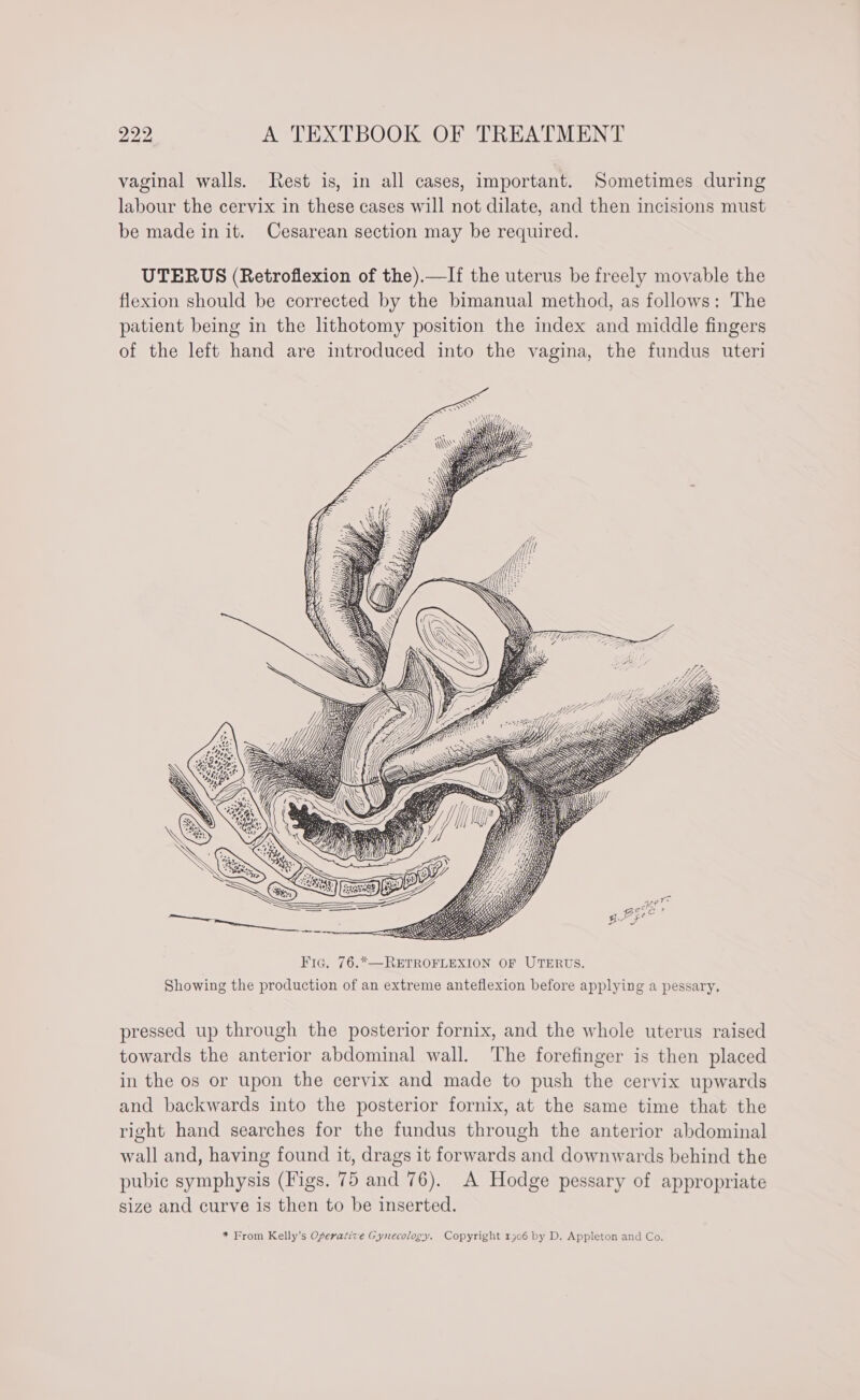 vaginal walls. Rest is, in all cases, important. Sometimes during labour the cervix in these cases will not dilate, and then incisions must be made in it. Cesarean section may be required. UTERUS (Retroflexion of the).—If the uterus be freely movable the flexion should be corrected by the bimanual method, as follows: The patient being in the lithotomy position the index and middle fingers of the left hand are introduced into the vagina, the fundus uteri : by [? uphiighe : Mk ES s . \ YX LZ. ih . se Bsi \ 55) K pressed up through the posterior fornix, and the whole uterus raised towards the anterior abdominal wall. ‘The forefinger is then placed in the os or upon the cervix and made to push the cervix upwards and backwards into the posterior fornix, at the same time that the right hand searches for the fundus through the anterior abdominal wall and, having found it, drags it forwards and downwards behind the pubic symphysis (Figs. 75 and 76). A Hodge pessary of appropriate size and curve is then to be inserted.