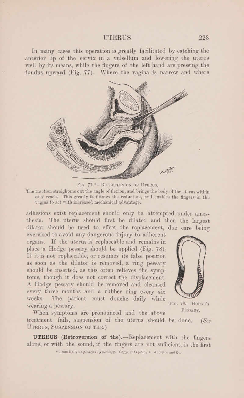 Fic. 77.*—RETROFLEXION OF UTERUS. vagina to act with increased mechanical advantage. exercised to avoid any dangerous injury to adherent organs. If the uterus is replaceable and remains in place a Hodge pessary should be applied (Fig. 78). If it is not replaceable, or resumes its false position as soon as the dilator is removed, a ring pessary should be inserted, as this often relieves the symp- toms, though it does not correct the displacement. A Hodge pessary should be removed and cleansed every three months and a rubber ring every six weeks. The patient must douche daily while wearing a pessary. When symptoms are pronounced and the above PESSARY, UTERUS, SUSPENSION OF THE.) (See