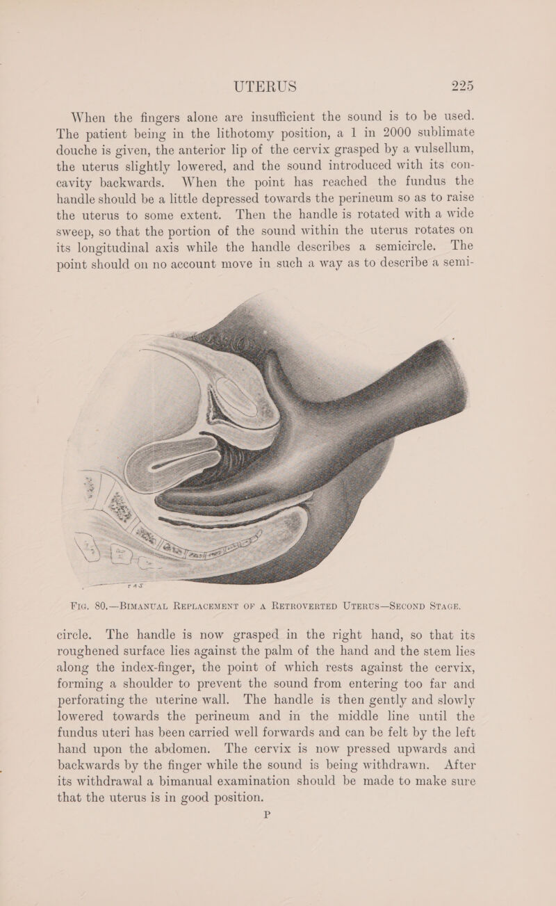 When the fingers alone are insufficient the sound is to be used. The patient being in the lithotomy position, a 1 in 2000 sublimate douche is given, the anterior lip of the cervix grasped by a vulsellum, the uterus slightly lowered, and the sound introduced with its con- cavity backwards. When the point has reached the fundus the handle should be a little depressed towards the perineum so as to raise the uterus to some extent. Then the handle is rotated with a wide sweep, so that the portion of the sound within the uterus rotates on its longitudinal axis while the handle describes a semicircle. The point should on no account move in such a way as to describe a sem1- Fic. 80.—BIMANUAL REPLACEMENT OF A RETROVERTED UTERUS—SECOND STAGE. circle. The handle is now grasped in the right hand, so that its roughened surface lies against the palm of the hand and the stem lies along the index-finger, the point of which rests against the cervix, forming a shoulder to prevent the sound from entering too far and perforating the uterine wall. The handle is then gently and slowly lowered towards the perineum and in the middle line until the fundus uteri has been carried well forwards and can be felt by the left hand upon the abdomen. The cervix is now pressed upwards and backwards by the finger while the sound is being withdrawn. After its withdrawal a bimanual examination should be made to make sure that the uterus is in good position. =