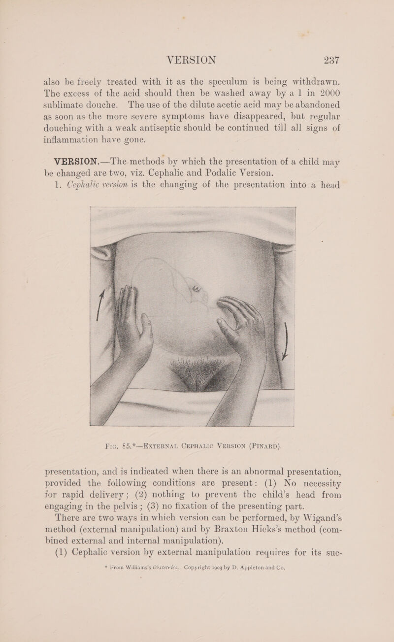 also be freely treated with it as the speculum is being withdrawn. The excess of the acid should then be washed away by a1 in 2000 sublimate douche. The use of the dilute acetic acid may be abandoned as soon as the more severe symptoms have disappeared, but regular douching with a weak antiseptic should be continued till all signs of inflammation have gone. VERSION.—The-methods by which the presentation of a child may be changed are two, viz. Cephalic and Podalic Version. 1. Cephalic version is the changing of the presentation into a head presentation, and is indicated when there is an abnormal presentation, provided the following conditions are present: (1) No necessity for rapid delivery ; (2) nothing to prevent the child’s head from engaging in the pelvis; (3) no fixation of the presenting part. There are two ways in which version can be performed, by Wigand’s method (external manipulation) and by Braxton Hicks’s method (com- bined external and internal manipulation). (1) Cephalic version by external manipulation requires for its suc-