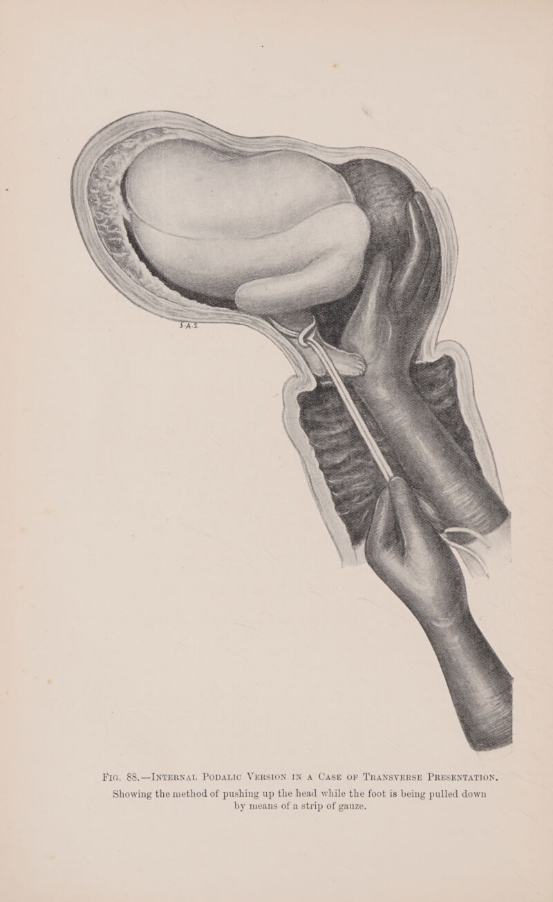 Fia. 88.—INTERNAL PODALIC VERSION IN A CASE OF TRANSVERSE PRESENTATIO Showing the method of pushing up the head while the foot is being pulled down by means of a strip of gauze.