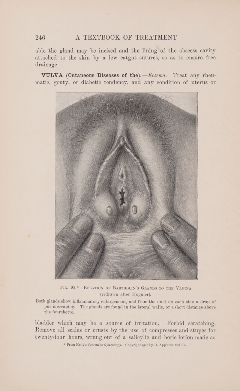 able the gland may be incised and the lining of the abscess cavity attached to the skin by a few catgut sutures, so as to ensure free drainage. VULVA (Cutaneous Diseases of the).—Hczema. Treat any rheu- matic, gouty, or diabetic tendency, and any condition of uterus or (redrawn after Huguier). Both glands show inflammatory enlargement, and from the duct on each side a drop of pus is escaping. The glands are found in the lateral walls, or a short distance above the fourchette. bladder which may be a source of irritation. Forbid scratching. Remove all scales or crusts by the use of compresses and stupes for twenty-four hours, wrung out of a salicylic and boric lotion made as * From Kelly’s Oferative Gynecology. Copyright 1996 by D, App'eton and Co.