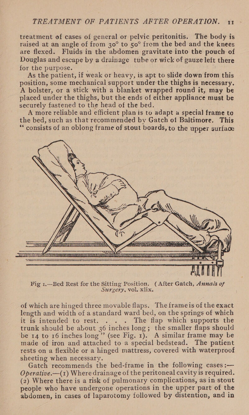 treatment of cases of general or pelvic peritonitis. The body is raised at an angle of from 30° to 50° from the bed and the knees are flexed. Fluids in the abdomen gravitate into the pouch of Douglas and escape by a drainage tube or wick of gauze left there for the purpose. ; As the patient, if weak or heavy, is apt to slide down from this position, some mechanical support under the thighs is necessary. A bolster, or a stick with a blanket wrapped round it, may be placed under the thighs, but the ends of either appliance must be securely fastened to the head of the bed. | A more reliable and efficient plan is to adapt a special frame to the bed, such as that recommended by Gatch of Baltimore. This ** consists of an oblong frame of stout boards, to the upper surface r. Ny, Se a TO Re rida reanietiler \, CS SY 4 SSS TEGQUURS RULER MEL x i] 6S : ro», \\ roig yr eeeblel eda eee Rea Bete UIC) RTS GE i Fig 1.—Bed Rest for the Sitting Position. (After Gatch, dunais of Surgery, vol. xlix. of which are hinged three movable flaps. The frameis of the exact length and width of a standard ward bed, on the springs of which it is intended to rest. . . . The flap which supports the trunk should be about 36 inches long; the smaller flaps should be 14 to 16 inches long ”’ (see Fig. 1). A similar frame may be made of iron and attached to a special bedstead. The patient rests on a flexible or a hinged mattress, covered with waterproof sheeting when necessary. Gatch recommends the bed-frame in the following cases :— Operative.—(1) Where drainage of the peritoneal cavity is required. (2) Where there is a risk of pulmonary complications, as in stout people who have undergone operations in the upper part of the abdomen, in cases of laparotomy followed by distention, and in