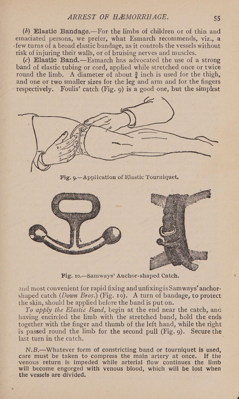 (4) Elastic Bandage.—For the limbs of children or of thin and emaciated persons, we prefer, what Esmarch recommends, viz., a -few turns of a broad elastic bandage, as it controls the vessels without risk of injuring their walls, or of bruising nerves and muscles. (c) Elastic Band.—Esmarch has advocated the use of a strong band of elastic tubing or cord, applied while stretched once or twice round the limb. A diameter of about 2 inch is used for the thigh, and one or two smaller sizes for the leg and arm and for the fingers respectively. Foulis’ catch (Fig. 9) is a good one, but the simplest oa) ee NN s and most convenient for rapid fixing and unfixingis Samways’ anchor- shaped catch (Down Bros.) (Fig. 10). A turn of bandage, to protect the skin, should be applied before the band is put on. To apply the Elastic Band, begin at the end near the catch, ana having encircled the limb with the stretched band, hold the ends together with the finger and thumb of the left hand, while the right is passed round the limb for the second pull (Fig. 9). Secure the last turn in the catch. N.B.—Whatever form of constricting band or tourniquet is used, care must be taken to compress the main artery at once. If the venous return is impeded while arterial flow continues the limb will become engorged with venous blood, which will be lost when the vessels are divided.