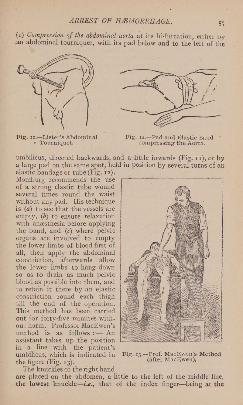 . ARREST OF HAiMORRHAGE. é: (1) Compression of the abdominal aorta at its bi-furcation, either by -an abdominal tourniquet, with its pad below and to the left of the Fig, 11.—Lister’s Abdominal Fig. 12,—Pad and Elastic Band » Yourniquet. compressing the Aorta. umbilicus, directed backwards, and a little inwards (Fig. 11), or by a large pad on the same spot, held in position by several turns of an elastic bandage or tube (Fig. 12). Momburg recommends the use of a strong elastic tube wound several times round the waist without any pad. His technique is (a) to see that the vessels are empty, () to ensure relaxation with anesthesia before applying the band, and (c) where pelvic organs are involved to empty | the lower limbs of blood first of © all, then apply the abdominal constriction, afterwards allow the lower limbs to hang down so as to drain as much pelvic | blood as possible into them, and | to retain it there by an elastic constriction round each thigh till the end of the operation. This method has been carried out for forty-five minutes with- ou: harm. Professor MacEwen’s method is as follows :— An assistant takes up the position in a line with the patient’s umbilicus, which is indicated in Fig. 13.—Prof. MacEwen’s Method the figure (Fig. 13). (after MacEKwen). The knuckles of the right hand are placed on the abdomen, a little to the left of the middle line, the lowest knuckle—7.e., that of the index finger—being at the