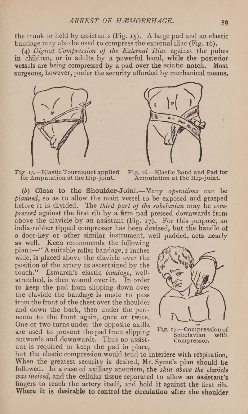 the trunk or held by assistants (Fig. 15). A large pad and an elastic bandage may also be used to compress the external iliac (Fig. 16). (4) Digital Compression of the External Iliac against the pubes in children, or in adults by a powerful hand, while the posterior vessels are being compressed by a pad over the sciatic notch. Most surgeons, however, prefer the security afforded by mechanical means. \ 4 KS are Fig. 15.—Elastic Tourniquet applied Fig. 16.—Elastic Band and Pad for for Amputation at the Hip-joint. Amputation at the Hip-joint. (b) Close to the Shoulder-Joint.—Many operations can be planned, so as to allow the main vessel to be exposed and grasped before it is divided. The third part of the subclavian may be com- pressed against the first rib by a farm pad pressed downwards from above the clavicle by an assistant (Fig. 17). For this purpose, an india-rubber tipped compressor has been devised, but the handle of a door-key or other similar instrument, well padded, acts nearly as well. Keen recommends the following plan :—‘“‘ A suitable roller bandage, 2 inches wide, is placed above the clavicle over the position of the artery as ascertained by the touch.”” Esmarch’s elastic bandage, well- stretched, is then wound over it. In order to keep the pad from slipping down over the clavicie the bandage is made to pass from the front of the chest over the shoulder and down the back, then under the peri- neum to the front again, qnce or twice. One or two turns under the opposite axilla _. de are used to prevent the pad from slipping *78 gf Pn pent ag asia outwards and downwards. Thus no assist- Compressor. ant is required to keep the pad in place, but the elastic compression would tend to interfere with respiration, When the greatest security is desired, Mr. Syme’s plan should be followed. In acase of axillary aneurism, the skin above the clavicle was incised, and the cellular tissue separated to allow an assistant’s fingers to reach the artery itself, and hold it against the first rib. Where it is desirable to control the circulation after the shoulder