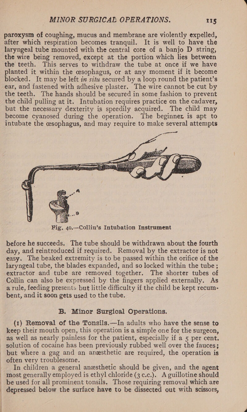 paroxysm of coughing, mucus and membrane are violently expelled, after which respiration becomes tranquil. It is well to have the laryngeal tube mounted with the central core of a banjo D string, the wire being removed, except at the portion which lies between the teeth. This serves to withdraw the tube at once if we have planted it within the cesophagus, or at any moment if it become blocked. It may be left 1” situ secured by a loop round the patient’s ear, and fastened with adhesive plaster. The wire cannot be cut by the teeth. The hands should be secured in some fashion to prevent the child pulling at it. Intubation requires practice on the cadaver, but the necessary dexterity is speedily acquired. The child may become cyanosed during the operation. The beginner is apt to intubate the oesophagus, and may require to make several attempts before he succeeds. The tube should be withdrawn about the fourth day, and reintroduced if required. Removal by the extractor is not easy. The beaked extremity is to be passed within the orifice of the laryngeal tube, the blades expanded, and so locked within the tube ; extractor and tube are removed together. The shorter tubes of Collin can also be expressed by the fingers applied externally. As a rule, feeding presents but little difficulty if the child be kept recum- bent, and it soon gets used to the tube. B. Minor Surgical Operations. (1) Removal of the Tonsils.—In adults who have the sense to keep their mouth open, this operation is a simple one for the surgeon, as well as nearly painless for the patient, especially if a 5 per cent. solution of cocaine has been previously rubbed well over the fauces; but where a gag and an anesthetic are required, the operation is In children a general anesthetic should be given, and the agent } depressed below the surface have to be dissected out with scissors,