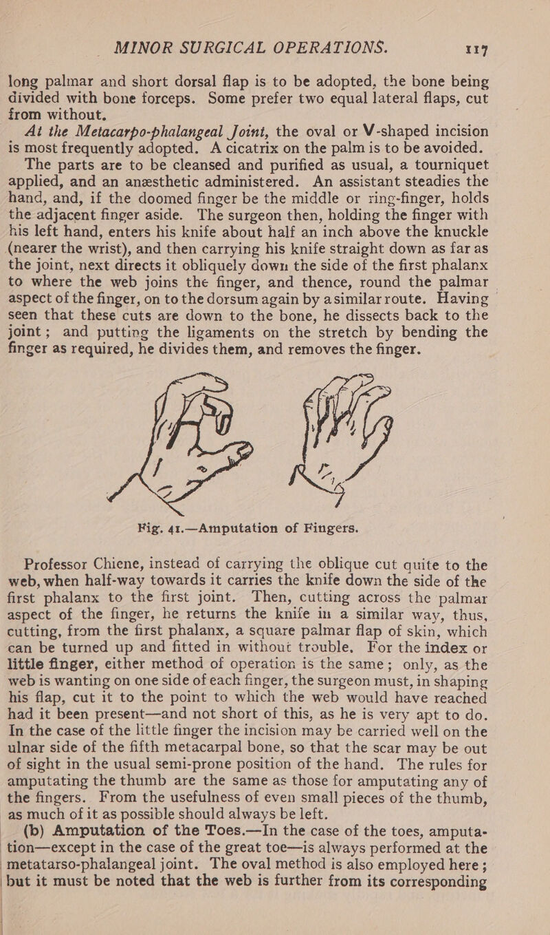 long palmar and short dorsal flap is to be adopted, the bone being divided with bone forceps. Some prefer two equal lateral flaps, cut from without. Ai the Metacarpo-phalangeal Joint, the oval or V-shaped incision is most frequently adopted. A cicatrix on the palm is to be avoided. The parts are to be cleansed and purified as usual, a tourniquet applied, and an anesthetic administered. An assistant steadies the hand, and, if the doomed finger be the middle or ring-finger, holds the adjacent finger aside. The surgeon then, holding the finger with his left hand, enters his knife about half an inch above the knuckle (nearer the wrist), and then carrying his knife straight down as far as the joint, next directs it obliquely down the side of the first phalanx to where the web joins the finger, and thence, round the palmar aspect of the finger, on to the dorsum again by asimilarroute. Having — seen that these cuts are down to the bone, he dissects back to the joint; and putting the ligaments on the stretch by bending the finger as required, he divides them, and removes the finger. Professor Chiene, instead of carrying the oblique cut quite to the web, when half-way towards it carries the knife down the side of the first phalanx to the first joint. Then, cutting across the palmar aspect of the finger, he returns the knife in a similar way, thus, cutting, from the first phalanx, a square palmar flap of skin, which can be turned up and fitted in without trouble, For the index or little finger, either method of operation is the same; only, as the web is wanting on one side of each finger, the surgeon must, in shaping his flap, cut it to the point to which the web would have reached had it been present—and not short of this, as he is very apt to do. In the case of the little finger the incision may be carried well on the ulnar side of the fifth metacarpal bone, so that the scar may be out of sight in the usual semi-prone position of the hand. The rules for amputating the thumb are the same as those for amputating any of the fingers. From the usefulness of even small pieces of the thumb, -as much of it as possible should always be left. _ (b) Amputation of the Toes.—In the case of the toes, amputa- _tion—except in the case of the great toe—is always performed at the _metatarso-phalangeal joint. The oval method is also employed here; but it must be noted that the web is further from its corresponding