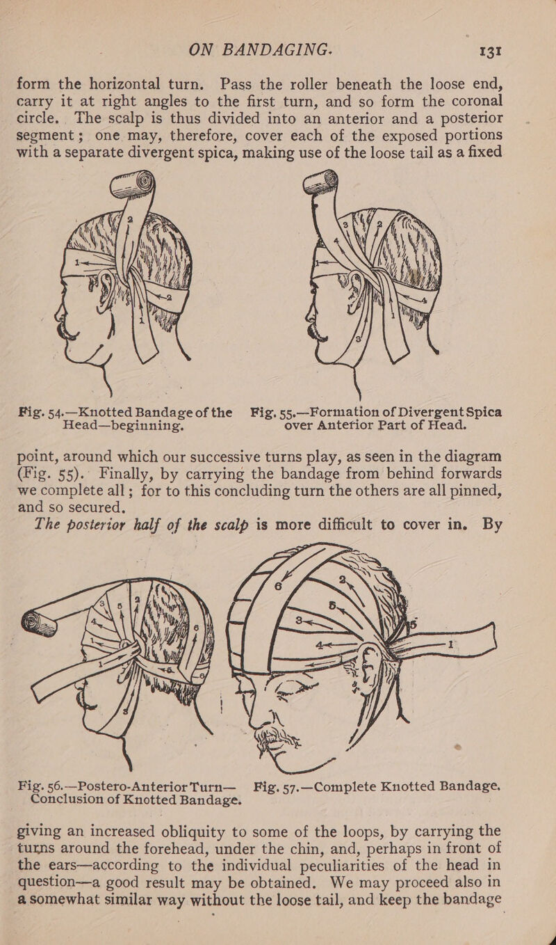 form the horizontal turn. Pass the roller beneath the loose end, carry it at right angles to the first turn, and so form the coronal circle. The scalp is thus divided into an anterior and a posterior segment; one may, therefore, cover each of the exposed portions with a separate divergent spica, making use of the loose tail as a fixed Fig. 54.—Knotted Bandageofthe Fig. 55.—Formation of Divergent Spica Head—beginning, over Antefior Part of Head. point, around which our successive turns play, as seen in the diagram (Fig. 55). Finally, by carrying the bandage from behind forwards we complete all; for to this concluding turn the others are all pinned, and so secured, The posterior half of the scalp is more difficult to cover in. By Fig. 56.—Postero-AnteriorTurn— Fig.57.—Complete Knotted Bandage. Conclusion of Knotted Bandage. giving an increased obliquity to some of the loops, by carrying the turns around the forehead, under the chin, and, perhaps in front of the ears—according to the individual peculiarities of the head in question—a good result may be obtained. We may proceed also in a somewhat similar way without the loose tail, and keep the bandage