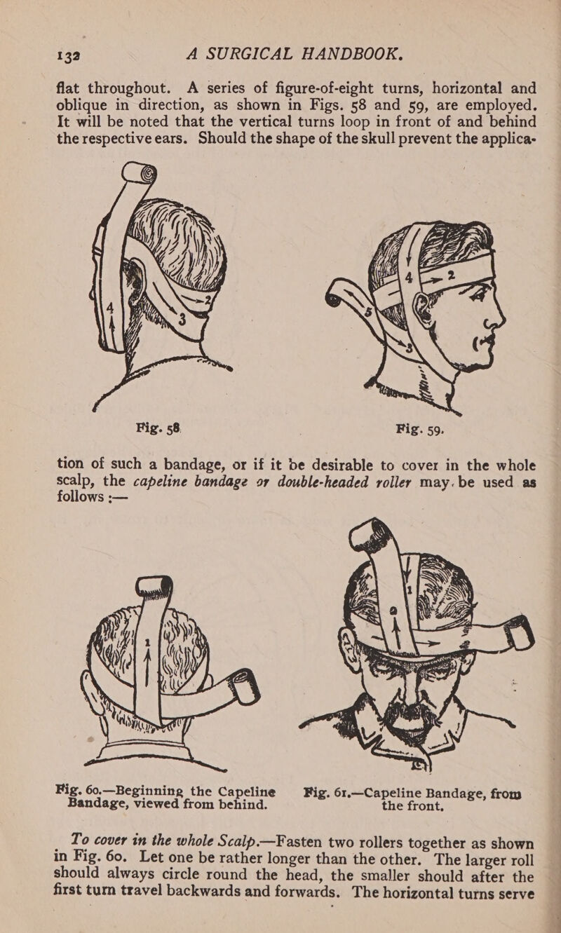 flat throughout. A series of figure-of-eight turns, horizontal and oblique in direction, as shown in Figs. 58 and 59, are employed. It will be noted that the vertical turns loop in front of and behind the respective ears. Should the shape of the skull prevent the applica- Fig. 58. Fig. 59. tion of such a bandage, or if it be desirable to cover in the whole aie the capeline bandage or double-headed roller may.be used as ollows :-— Fig. 60.—Beginning the Capeline Fig. 61.—Capeline Bandage, fro Bandage, viewed from behind. 7 the front, spate: _ To cover in the whole Scalp.—Fasten two rollers together as shown in Fig. 60. Let one be rather longer than the other. The larger roll should always circle round the head, the smaller should after the first turn travel backwards and forwards. The horizontal turns serve a