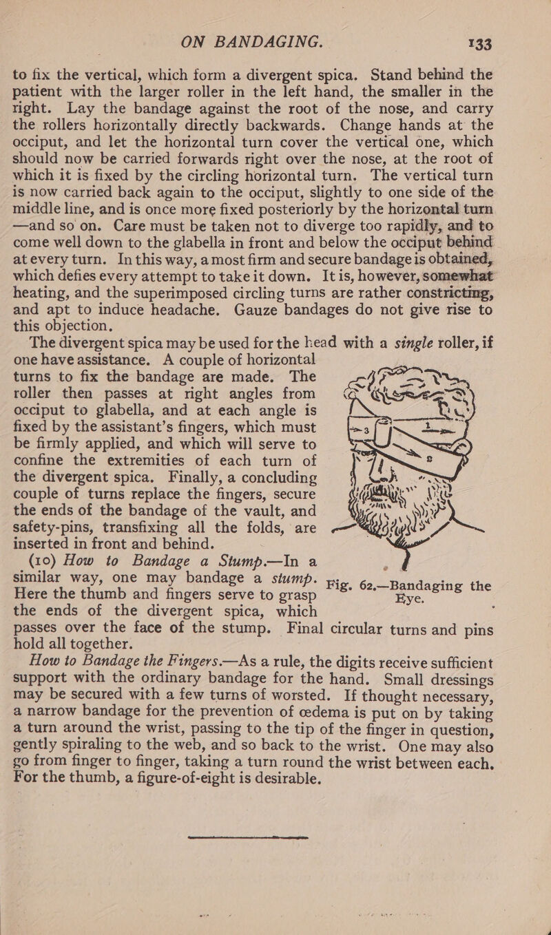 to fix the vertical, which form a divergent spica. Stand behind the patient with the larger roller in the left hand, the smaller in the right. Lay the bandage against the root of the nose, and carry the rollers horizontally directly backwards. Change hands at the occiput, and let the horizontal turn cover the vertical one, which should now be carried forwards right over the nose, at the root of which it is fixed by the circling horizontal turn. The vertical turn is now carried back again to the occiput, slightly to one side of the middle line, and is once more fixed posteriorly by the horizontal turn —and soon. Care must be taken not to diverge too rapidly, and to come well down to the glabella in front and below the occiput behind atevery turn. In this way, a most firm and secure bandage is obtained, which defies every attempt to take it down. It is, however, somewhat heating, and the superimposed circling turns are rather constrictmg, and apt to induce headache. Gauze bandages do not give rise to this objection, The divergent spica may be used for the head with a single roller, if one have assistance. A couple of horizontal turns to fix the bandage are made. The roller then passes at right angles from occiput to glabella, and at each angle is fixed by the assistant’s fingers, which must be firmly applied, and which will serve to confine the extremities of each turn of the divergent spica. Finally, a concluding Neh SS couple of turns replace the fingers, secure (eee Re the ends of the bandage of the vault, and Wore E Wh safety-pins, transfixing all the folds, are ——“«yo% nS rs inserted in front and behind. (10) How to Bandage a Stump—lIn a a | similar way, one may bandage a stump. Here the thumb and fingers serve to grasp the ends of the divergent spica, which passes over the face of the stump. Final circular turns and pins hold all together. How to Bandage the Fingers —As a rule, the digits receive sufficient support with the ordinary bandage for the hand. Small dressings may be secured with a few turns of worsted. If thought necessary, a narrow bandage for the prevention of cedema is put on by taking a turn around the wrist, passing to the tip of the finger in question, gently spiraling to the web, and so back to the wrist. One may also go from finger to finger, taking a turn round the wrist between each. For the thumb, a figure-of-eight is desirable. Fig. 62,—Bandaging the Eye. é