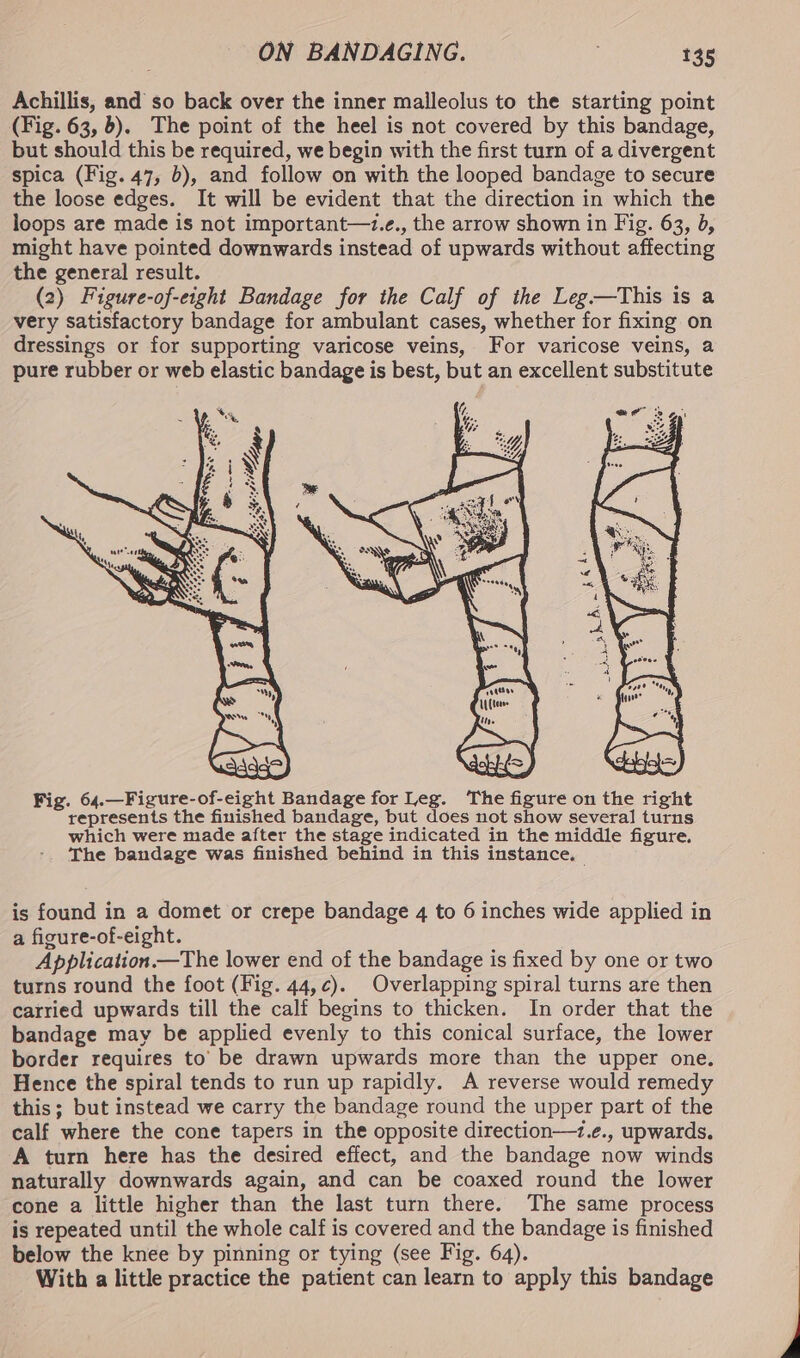 Achillis, and so back over the inner malleolus to the starting point (Fig. 63, 6). The point of the heel is not covered by this bandage, but should this be required, we begin with the first turn of a divergent spica (Fig. 47, 0), and follow on with the looped bandage to secure the loose edges. It will be evident that the direction in which the loops are made is not important—+.e., the arrow shown in Fig. 63, 0, might have pointed downwards instead of upwards without affecting the general result. (2) Figure-of-eight Bandage for the Calf of the Leg—This is a very satisfactory bandage for ambulant cases, whether for fixing on dressings or for supporting varicose veins, For varicose veins, a pure rubber or web elastic bandage is best, but an excellent substitute Fig. 64.—Figure-of-eight Bandage for Leg. The figure on the right represents the finished bandage, but does not show several turns which were made after the stage indicated in the middle figure. The bandage was finished behind in this instance, is found in a domet or crepe bandage 4 to 6 inches wide applied in a figure-of-eight. Application.—The lower end of the bandage is fixed by one or two turns round the foot (Fig. 44,¢c). Overlapping spiral turns are then carried upwards till the calf begins to thicken. In order that the bandage may be applied evenly to this conical surface, the lower border requires to’ be drawn upwards more than the upper one. Hence the spiral tends to run up rapidly. A reverse would remedy this; but instead we carry the bandage round the upper part of the calf where the cone tapers in the opposite direction—+z.e., upwards. A turn here has the desired effect, and the bandage now winds naturally downwards again, and can be coaxed round the lower cone a little higher than the last turn there. The same process is repeated until the whole calf is covered and the bandage is finished below the knee by pinning or tying (see Fig. 64). With a little practice the patient can learn to apply this bandage