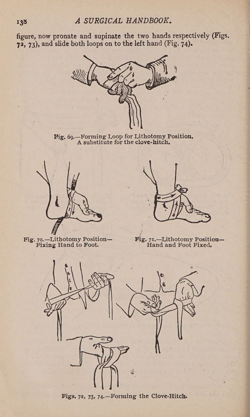 figure, now pronate and supinate the two hands respectively (Figs. 42, 73), and slide both loops on to the left hand (Fig. 74). Big. 69.—Forming Loop for Lithotomy Position, A substitute for the clove-hitch. J Fig. 70. —Lithotomy Position— Fig. 71.—Lithotomy Positiou— Fixing Hand to Foot. Hand and Foot Fixed.