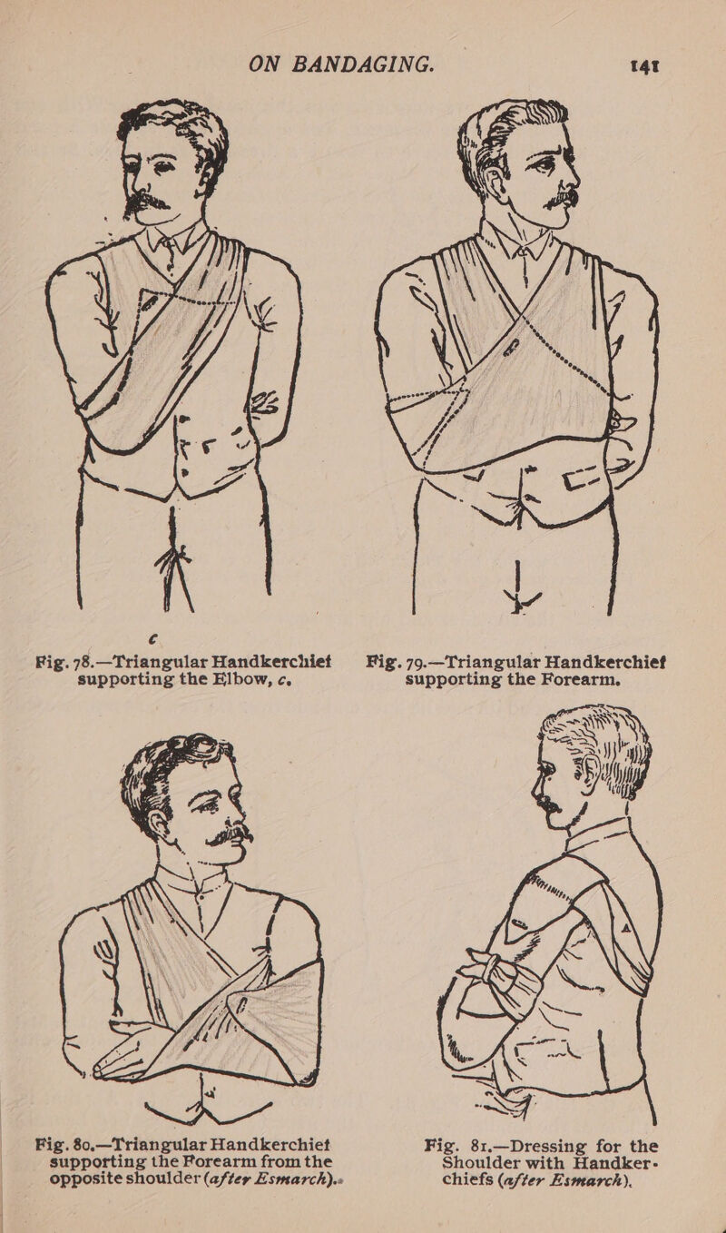 *Big. 80.—Triangular Handkerchiet Fig. 81.—Dressing for the | supporting the Forearm from the Shoulder with Handker- opposite shoulder (after Esmarch).« chiefs (after Esmarch).