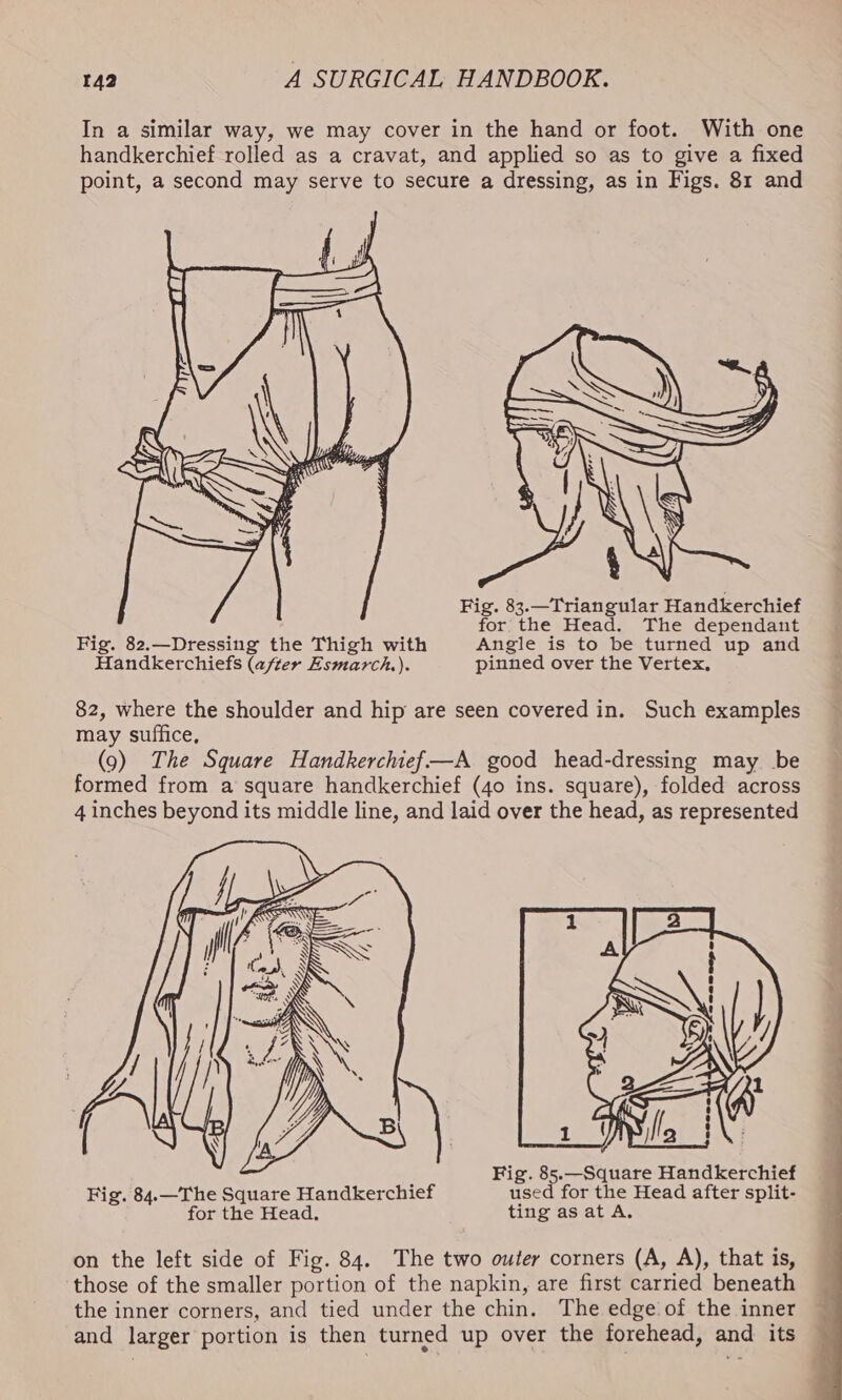 In a similar way, we may cover in the hand or foot. With one handkerchief rolled as a cravat, and applied so as to give a fixed point, a second may serve to secure a dressing, as in Figs. 81 and Fig. 83.—Triangular Handkerchief for the Head. The dependant Fig. 82,—Dressing the Thigh with Angle is to be turned up and Handkerchiefs (after Esmarch.). pinned over the Vertex, 82, where the shoulder and hip are seen covered in. Such examples may suffice, (9) The Square Handkerchief —A good head-dressing may be formed from a square handkerchief (40 ins. square), folded across 4 inches beyond its middle line, and laid over the head, as represented Fig. 85.—Square Handkerchief Fig. 84.—The Square Handkerchief used for the Head after split- for the Head, ting as at A. on the left side of Fig. 84. The two outer corners (A, A), that is, those of the smaller portion of the napkin, are first carried beneath the inner corners, and tied under the chin. The edge of the inner and larger portion is then turned up over the forehead, and its