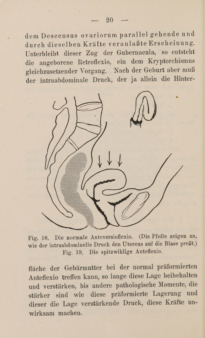 a dem Descensus ovariorum parallel gehende und durch dieselben Kräfte veranlaßte Erscheinung. Unterbleibt dieser Zug der Gubernacula, so entsteht die angeborene Retroflexio, ein dem Kryptorchismus gleichzusetzender Vorgang. Nach der Geburt aber mub der intraabdominale Druck, der ja allein die Hinter- Fig. 18. Die normale Anteversioflexio. (Die Pfeile zeigen an, wie der intraabdominelle Druck den Utereus auf die Blase preßt.) Fig. 19. Die spitzwiklige Anteflexio. fläche der Gebärmutter bei der normal präformierten Anteflexio treffen kann, so lange diese Lage beibehalten und verstärken, bis andere pathologische Momente, die stärker sind wie diese präformierte Lagerung und dieser die Lage verstärkende Druck, diese Kräfte un- wirksam machen. |