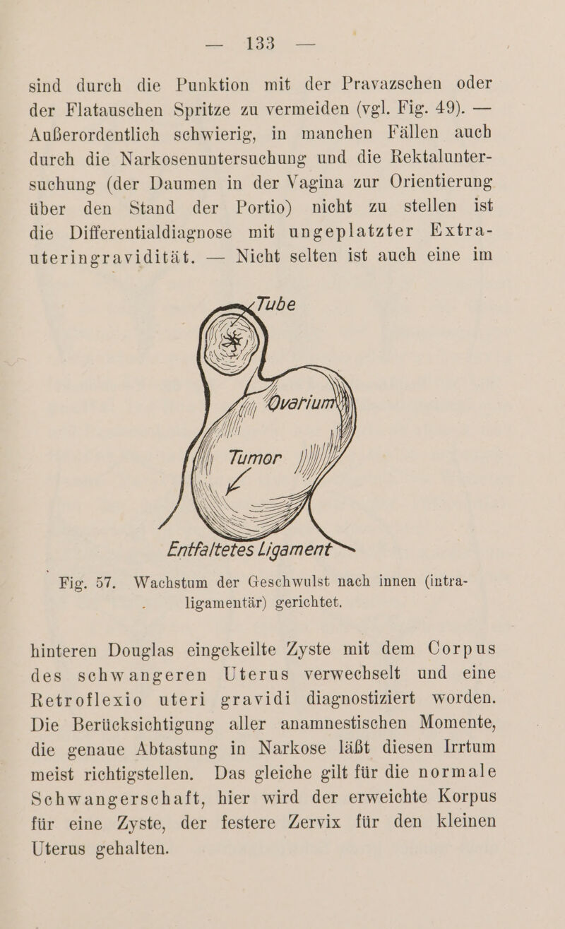 sind durch die Punktion mit der Pravazschen oder der Flatauschen Spritze zu vermeiden (vgl. Fig. 49). — Außerordentlich schwierig, in manchen Fällen aueh durch die Narkosenuntersuchung und die Rektalunter- suchung (der Daumen in der Vagina zur Orientierung über den Stand der Portio) nicht zu stellen ist die Differentialdiagnose mit ungeplatzter Extra- uteringravidität. — Nicht selten ist auch eine im > Entfaltetes Ligament Fig. 57. Wachstum der Geschwulst nach innen (intra- ligamentär) gerichtet. hinteren Douglas eingekeilte Zyste mit dem Gorpus des schwangeren Uterus verwechselt und eine Retroflexio uteri gravidi diagnostiziert worden. Die Berücksichtigung aller anamnestischen Momente, die genaue Abtastung in Narkose läßt diesen Irrtum meist richtigstellen. Das gleiche gilt für die normale Schwangerschaft, hier wird der erweichte Korpus für eine Zyste, der festere Zervix für den kleinen Uterus gehalten.