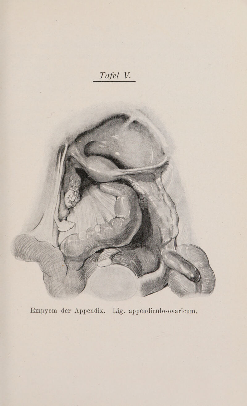 -ovaricum. Lig. appendiculo Empyem der Appendix.