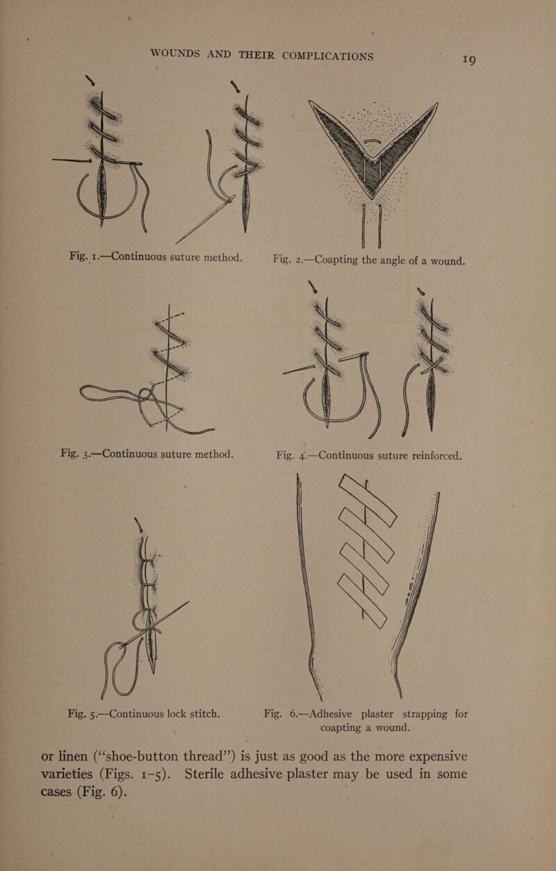 Fig. 1.—Continuous suture method. Fig. 2.—Coapting the angle of a wound. \ . Fig. 3—Continuous suture method. Fig. 4.—Continuous suture reinforced. Fig. 5.—Continuous lock stitch. Fig. 6.—Adhesive plaster strapping for coapting a wound. . or linen (“shoe-button thread”) is just as good as the more expensive varieties (Figs. 1-5). Sterile adhesive plaster may be used in some cases: (Fig. 6). ;