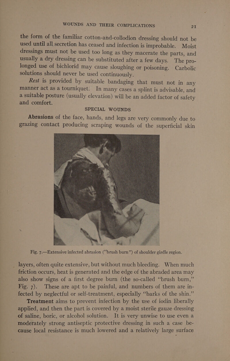 the form of the familiar cotton-and-collodion dressing should not be used until all secretion has ceased and infection is improbable. Moist dressings must not be used too long as they macerate the parts, and usually a dry dressing can be substituted after a few days. The pro- longed use of bichlorid may cause sloughing or poisoning. Carbolic solutions should never be used continuously. Rest is provided by suitable bandaging that must not in any manner act as a tourniquet. In many cases a splint is advisable, and a suitable posture (usually elevation) will be an added factor of safety and comfort. SPECIAL WOUNDS Abrasions of the face, hands, and legs are very commonly due to grazing contact producing scraping wounds of the superficial skin Fig. 7.—Extensive infected abrasion (‘‘brush burn”) of shoulder girdle region. layers, often quite extensive, but without much bleeding. When much friction occurs, heat is generated and the edge of the abraded area may also show signs of a first degree burn (the so-called “brush burn,” Fig. 7). These are apt to be painful, and numbers of them are in- fected by neglectful or self-treatment, especially “barks of the shin.”’ Treatment aims to prevent infection by the use of iodin liberally applied, and then the part is covered by a moist sterile gauze dressing of saline, boric, or alcohol solution. It is very unwise to use even a moderately strong antiseptic protective dressing in such a case _be- cause local resistance is much lowered and a relatively large surface