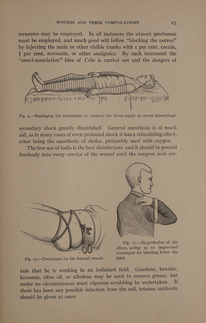 ‘measures may be employed. In all instances the utmost gentleness must be employed, and much good will follow “blocking the nerves” by injecting the main or other visible trunks with 1 per cent. cocain, 3 per cent. novocain, or other analgesics. By such treatment the “anoci-association” idea of Crile is carried out and the dangers of 4 Se iq) ui i) | l na = as Ue ne MM A Gengene y eNHEP ———— “ye | Fig. 9.—Bandaging the extremities to conserve the blood-supply in severe hemorrhage. secondary shock greatly diminished. General anesthesia is of much aid, as in many cases of even profound shock it has a stimulating effect, ether being the anesthetic of choice, preferably used with oxygen. The free use of iodin is the best disinfectant, and it should be poured fearlessly into every crevice of the wound until the surgeon feels cer- ceo aga = isa wove Seare Soe noc ares ss EES ses Fig. 11.—Hyperflexion of the elbow, acting as an improvised tourniquet for bleeding below the Fig. 10.—Tourniquet for the femoral vessels. - joint. tain that he is working in an iodinized field. Gasolene, benzine, kerosene, olive oil, or albolene may be used to remove grease, but under no circumstances must vigorous scrubbing be undertaken. It there has been any possible infection from the soil, tetanus antitoxin should be given at once.