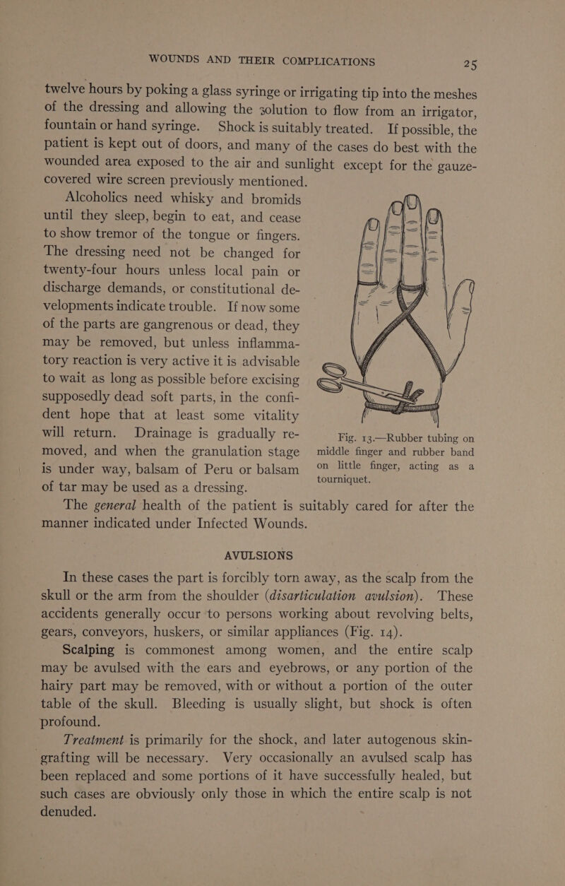 twelve hours by poking a glass syringe or irrigating tip into the meshes of the dressing and allowing the solution to flow from an irrigator, fountain or hand syringe. Shock is suitably treated. If possible, the patient is kept out of doors, and many of the cases do best with the wounded area exposed to the air and sunlight except for the gauze- covered wire screen previously mentioned. Alcoholics need whisky and bromids until they sleep, begin to eat, and cease to show tremor of the tongue or fingers. The dressing need not be changed for twenty-four hours unless local pain or discharge demands, or constitutional de- 2 As velopments indicate trouble. If now some of the parts are gangrenous or dead, they may be removed, but unless inflamma- tory reaction is very active it is advisable to wait as long as possible before excising supposedly dead soft parts, in the confi- dent hope that at least some vitality will return. Drainage is gradually re- Fig. 13.—Rubber tubing on moved, and when the granulation stage middle finger and rubber band is under way, balsam of Peru or balsam aan see ne. aS a of tar may be used as a dressing. The general health of the patient is suitably cared for after the manner indicated under Infected Wounds. seca = im = yA AVULSIONS In these cases the part is forcibly torn away, as the scalp from the skull or the arm from the shoulder (disarticulation avulsion). These accidents generally occur to persons working about revolving belts, gears, conveyors, huskers, or similar appliances (Fig. 14). Scalping is commonest among women, and the entire scalp may be avulsed with the ears and eyebrows, or any portion of the hairy part may be removed, with or without a portion of the outer table of the skull. Bleeding is usually slight, but shock is often profound. Treatment is primarily for the shock, and later autogenous skin- grafting will be necessary. Very occasionally an avulsed scalp has been replaced and some portions of it have successfully healed, but such cases are obviously only those in which the entire scalp is not denuded.