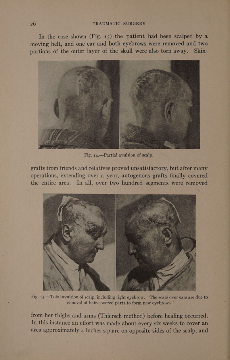 In the case shown (Fig. 15) the patient had been scalped by a moving belt, and one ear and both eyebrows were removed and two portions of the outer layer of the skull were also torn away. Skin- Cook Fig. 14.—Partial avulsion of scalp. grafts from friends and relatives proved unsatisfactory, but after many operations, extending over a year, autogenous grafts finally covered the entire area. In all, over two hundred segments were removed Fig. 15.—Total avulsion of scalp, including right eyebrow. The scars over ears are due to removal of hair-covered parts to form new eyebrows. — from her thighs and arms (Thiersch method) before healing occurred. In this instance an effort was made about every six weeks to cover an area approximately 4 inches square on opposite sides of the scalp, and