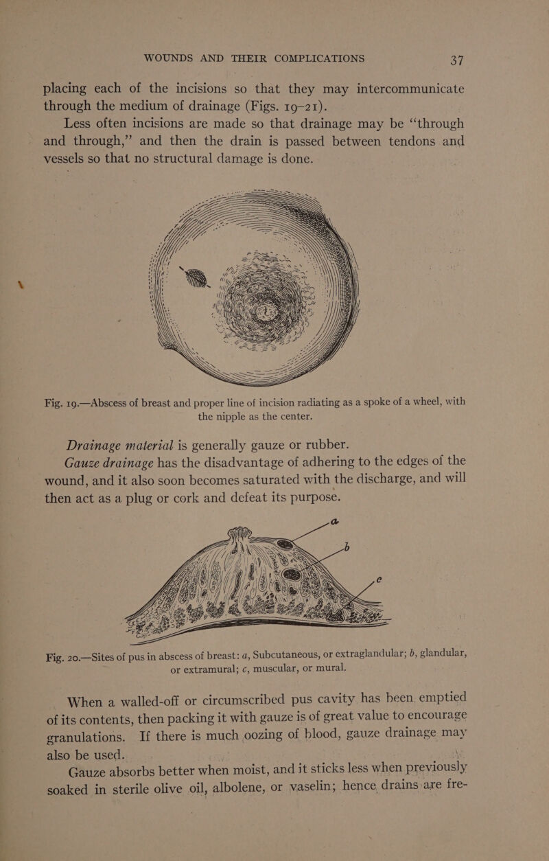 placing each of the incisions so that they may intercommunicate through the medium of drainage (Figs. 19-21). Less often incisions are made so that drainage may be “through and through,” and then the drain is passed between tendons and vessels so that no structural damage is done. | Fig. 19.—Abscess of breast and proper line of incision radiating as a spoke of a wheel, with the nipple as the center. Drainage material is generally gauze or rubber. Gauze drainage has the disadvantage of adhering to the edges of the wound, and it also soon becomes saturated with the discharge, and will then act as a plug or cork and defeat its purpose. iy ” (a [/ Tal “ Fig. 20.—Sites of pus in abscess of breast: a, Subcutaneous, or extraglandular; b, glandular, or extramural; c, muscular, or mural. - When a walled-off or circumscribed pus cavity has been. emptied - of its contents, then packing it with gauze is of great value to encourage granulations. If there is much oozing of blood, gauze drainage may also be used. __ | \. Gauze absorbs better when moist, and it sticks less when previously soaked in sterile olive oil, albolene, or vaselin; hence, drains are fre-