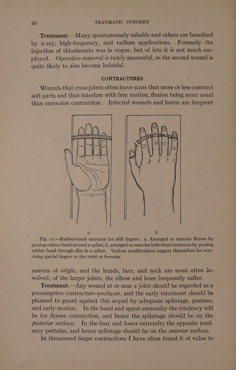 Treatment.—Many spontaneously subside and others are benefited by «x-ray, high-frequency, and radium applications. Formerly the injection of thiosinamin was in vogue, but of late it is not much em- ployed. Operative removal is rarely successful, as the second wound is quite likely to also become keloidal. CONTRACTURES Wounds that cross joints often leave scars that more or less contract soft parts and thus interfere with free motion, flexion being more usual than extension contraction. Infected wounds and burns are frequent Fig. 22.—Rubber-band exerciser for stiff fingers: a, Arranged to exercise flexors by passing rubber band around a splint; b, arranged to exercise individual extensors by passing rubber band through slits in a splint. Various modifications suggest themselves for exer- cising special fingers or the wrist or forearm. sources of origin, and the hands, face, and neck are most often in- volved; of the larger joints, the elbow and knee frequently suffer. Treatment.—Any wound at or near a joint should be regarded as a presumptive contracture-producer, and the early treatment should be planned to guard against this sequel by adequate splintage, posture, and early motion. In the hand and upper extremity the tendency will be for flexure contraction, and hence the splintage should be on the posterior surface. In the foot and lower extremity the opposite tend- ency pertains, and hence splintage should be on the anterior surface. In threatened finger contractions I have often found it of value to