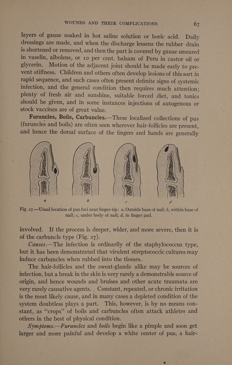 layers of gauze soaked in hot saline solution or boric acid. Daily dressings are made, and when the discharge lessens the rubber drain is shortened or removed, and then the part is covered by gauze smeared in vaselin, albolene, or 10 per cent. balsam of Peru in castor oil or glycerin. Motion of the adjacent joint should be made early to pre- vent stiffness. Children and others often develop lesions of this sort in rapid sequence, and such cases often present definite signs of systemic infection, and the general condition then requires much attention; plenty of fresh air and sunshine, suitable forced diet, and tonics should be given, and in some instances injections of autogenous or stock vaccines are of great value. Furuncles, Boils, Carbuncles.—These localized collections of pus (furuncles and boils) are often seen wherever hair-follicles are present, and hence the dorsal surface of the fingers and hands are generally Fig. 27.—Usual location of pus foci near finger-tip: a, Outside base of nail; b, within base of nail; c, under body of nail; d, in finger pad. involved. If the process is deeper, wider, and more severe, then it is of the carbuncle type (Fig. 27). Causes.—The infection is ordinarily of the staphylococcus type, but it has been demonstrated that virulent streptococcic cultures may induce carbuncles when rubbed into the tissues. The hair-follicles and the sweat-glands alike may be sources of infection, but a break in the skin is very rarely a demonstrable source of origin, and hence wounds and bruises and other acute traumata are very rarely causative agents. , Constant, repeated, or chronic irritation is the most likely cause, and in many cases a depleted condition of the system doubtless plays a part. This, however, is by no means con- stant, as “crops” of boils and carbuncles often attack athletes and others in the best of physical condition. | Sympioms.—Furuncles and boils begin like a pimple and soon get larger and more painful and develop a white center of pus, a hair-