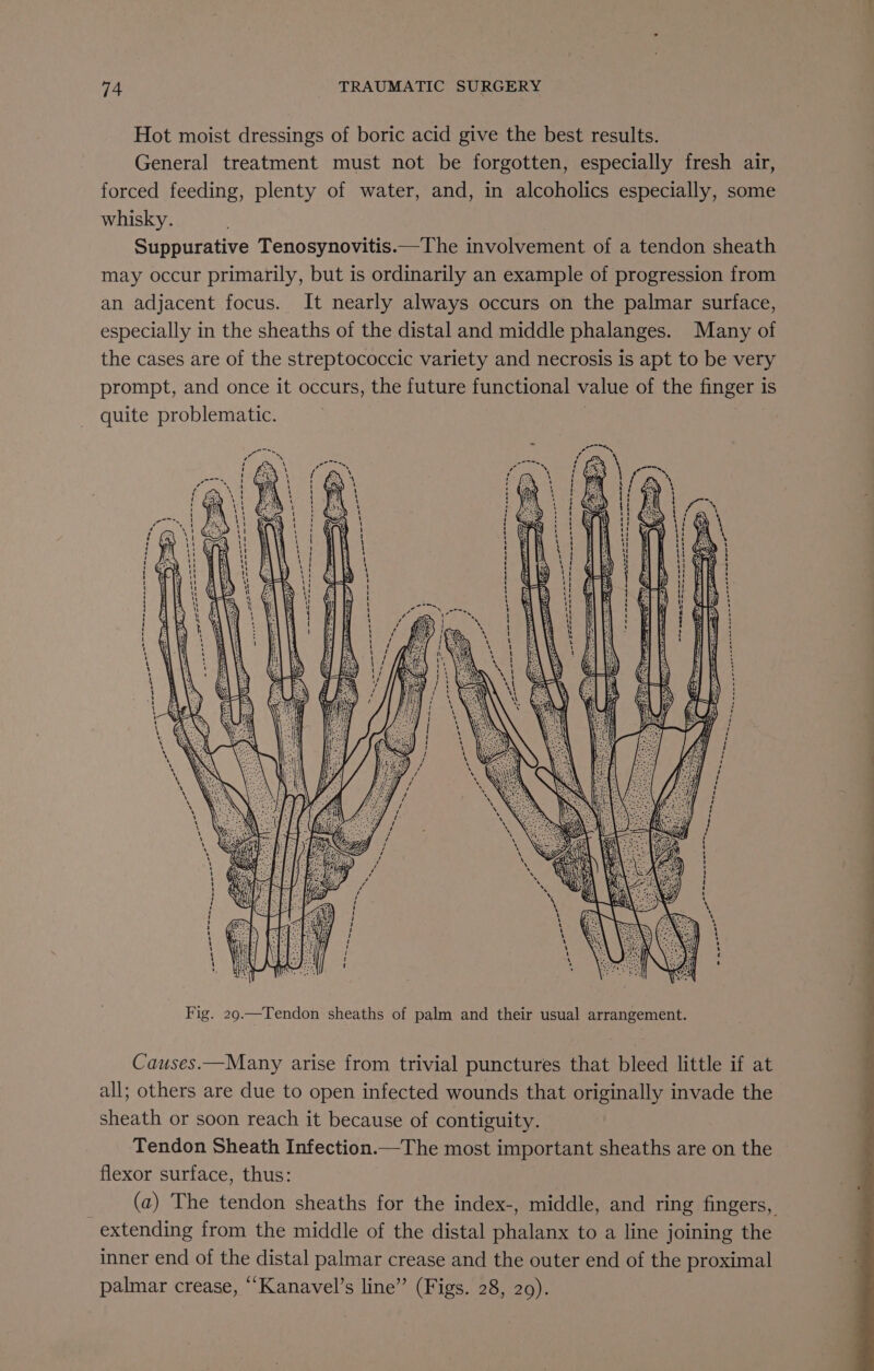 Hot moist dressings of boric acid give the best results. General treatment must not be forgotten, especially fresh air, forced feeding, plenty of water, and, in alcoholics especially, some whisky. Suppurative Tenosynovitis.—The involvement of a tendon sheath may occur primarily, but is ordinarily an example of progression from an adjacent focus. It nearly always occurs on the palmar surface, especially in the sheaths of the distal and middle phalanges. Many of the cases are of the streptococcic variety and necrosis is apt to be very prompt, and once it occurs, the future functional value of the finger is quite problematic. eae pe) oan oer wor se: 1. \ ES ee Sen Ae ee = A SSE) fe 2 SPR Tia Sac == i = =. — ey =as = 2 = = iN =n, Ls = ee oa a an a en a : sae -, .. Ty / SSS es s Fig. 29.—Tendon sheaths of palm and their usual arrangement. Causes.—Many arise from trivial punctures that bleed little if at all; others are due to open infected wounds that originally invade the sheath or soon reach it because of contiguity. Tendon Sheath Infection.—The most important sheaths are on the flexor surface, thus: (a) The tendon sheaths for the index-, middle, and ring fingers, extending from the middle of the distal phalanx to a line joining the inner end of the distal palmar crease and the outer end of the proximal palmar crease, ““Kanavel’s line” (Figs. 28, 29).