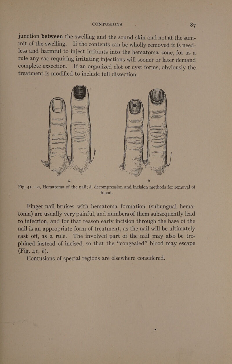 junction between the swelling and the sound skin and not at the sum- mit of the swelling. If the contents can be wholly removed it is need- less and harmful to inject irritants into the hematoma zone, for as a rule any sac requiring irritating injections will sooner or later demand complete exsection. If an organized clot or cyst forms, obviously the treatment is modified to include full dissection. wil ( \\ . BBB 5 a b Fig. 41.—a, Hematoma of the nail; 6, decompression and incision methods for removal of blood. Finger-nail bruises with hematoma formation (subungual hema- toma) are usually very painful, and numbers of them subsequently lead to infection, and for that reason early incision through the base of the nail is an appropriate form of treatment, as the nail will be ultimately cast off, as a rule. The involved part of the nail may also be tre- phined instead of incised, so that the ‘‘congealed” blood may escape (Fig. 41, 0). , Contusions of special regions are elsewhere considered.