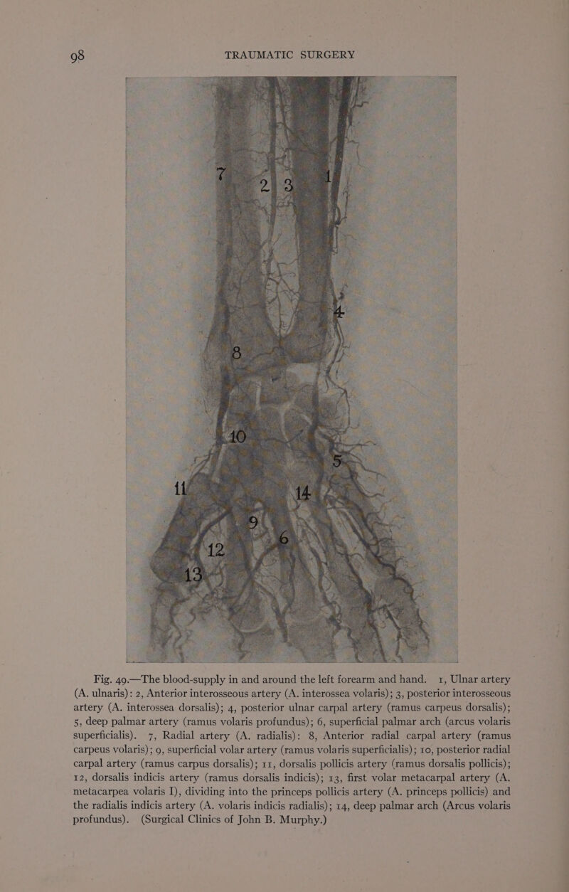 Fig. 49.—The blood-supply in and around the left forearm and hand. 1, Ulnar artery (A. ulnaris): 2, Anterior interosseous artery (A. interossea volaris); 3, posterior interosseous artery (A. interossea dorsalis); 4, posterior ulnar carpal artery (ramus carpeus dorsalis); 5, deep palmar artery (ramus volaris profundus); 6, superficial palmar arch (arcus volaris superficialis). 7, Radial artery (A. radialis): 8, Anterior radial carpal artery (ramus carpeus volaris); 9, superficial volar artery (ramus volaris superficialis) ; 10, posterior radial carpal artery (ramus carpus dorsalis); 11, dorsalis pollicis artery (ramus dorsalis pollicis) ; 12, dorsalis indicis artery (ramus dorsalis indicis); 13, first volar metacarpal artery (A. metacarpea volaris I), dividing into the princeps pollicis artery (A. princeps pollicis) and the radialis indicis artery (A. volaris indicis radialis); 14, deep palmar arch (Arcus volaris