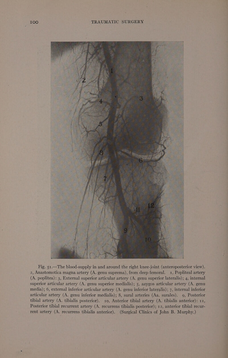 Fig. 51.—The blood-supply in and around the right knee-joint (anteroposterior view). 2, Anastomotica magna artery (A. genu suprema), from deep femoral. 1, Popliteal artery (A. poplitea): 3, External superior articular artery (A. genu superior lateralis); 4, internal superior articular artery (A. genu superior medialis); 5, azygos articular artery (A. genu media); 6, external inferior articular artery (A. genu inferior lateralis); 7, internal inferior articular artery (A. genu inferior medialis); 8, sural arteries (Aa. surales). 9, Posterior tibial artery (A. tibialis posterior). 1o, Anterior tibial artery (A. tibialis anterior): 11, Posterior tibial recurrent artery (A. recurrens tibialis posterior); 12, anterior tibial recur- rent artery (A. recurrens tibialis anterior). (Surgical Clinics of John B. Murphy.)