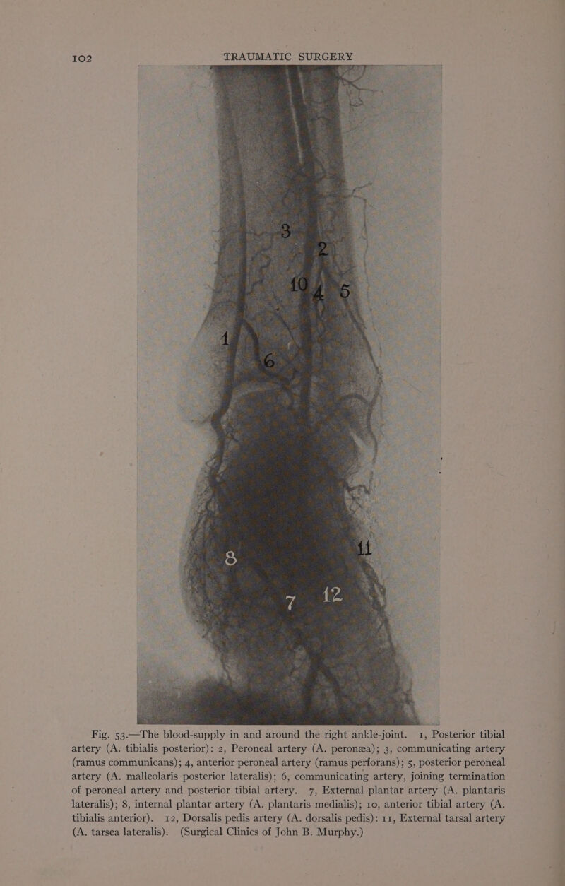 s Fig. 53.—The blood-supply in and around the right ankle-joint. 1, Posterior tibial artery (A. tibialis posterior): 2, Peroneal artery (A. peronea); 3, communicating artery (ramus communicans); 4, anterior peroneal artery (ramus perforans); 5, posterior peroneal artery (A. malleolaris posterior lateralis); 6, communicating artery, joining termination of peroneal artery and posterior tibial artery. 7, External plantar artery (A. plantaris lateralis); 8, internal plantar artery (A. plantaris medialis); 10, anterior tibial artery (A. tibialis anterior). 12, Dorsalis pedis artery (A. dorsalis pedis): 11, External tarsal artery (A. tarsea lateralis). (Surgical Clinics of John B. Murphy.)