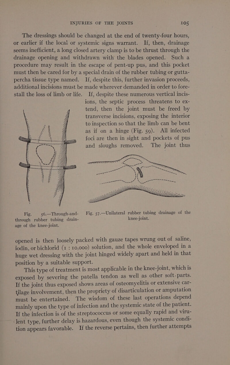 The dressings should be changed at the end of twenty-four hours, or earlier if the locai or systemic signs warrant. If, then, drainage seems inefficient, a long closed artery clamp is to be thrust through the drainage opening and withdrawn with the blades opened. Such a procedure may result in the escape of pent-up pus, and this pocket must then be cared for by a special drain of the rubber tubing or gutta- percha tissue type named. Ii, despite this, further invasion proceeds, additional incisions must be made wherever demanded in order to fore- stall the loss of limb or life. If, despite these numerous vertical incis- ions, the septic process threatens to ex- tend, then the joint must be freed by transverse incisions, exposing the interior to inspection so that the limb can be bent as if on a hinge (Fig. 59). All infected foci are then in sight and pockets of pus day cia | and sloughs removed. ‘The joint thus SSS ~ Fig. s6.—Through-and- Fig. 57.—Unilateral rubber tubing drainage of the through rubber tubing drain- knee-joint. age of the knee-joint. opened is then loosely packed with gauze tapes wrung out of saline, iodin, or bichlorid (1 : 10,000) solution, and the whole enveloped in a huge wet dressing with the joint hinged widely apart and held in that position by a suitable support. . This type of treatment is most applicable in the knee-joint, which is exposed by severing the patella tendon as well as other soit-parts. If the joint thus exposed shows areas of osteomyelitis or extensive car- tilage involvement, then the propriety of disarticulation or amputation must be entertained. The wisdom of these last operations depend mainly upon the type of infection and the systemic state of the patient. If the infection is of the streptococcus or some equally rapid and viru- lent type, further delay is hazardous, even though the systemic condi- tion appears favorable. Ii the reverse pertains, then further attempts