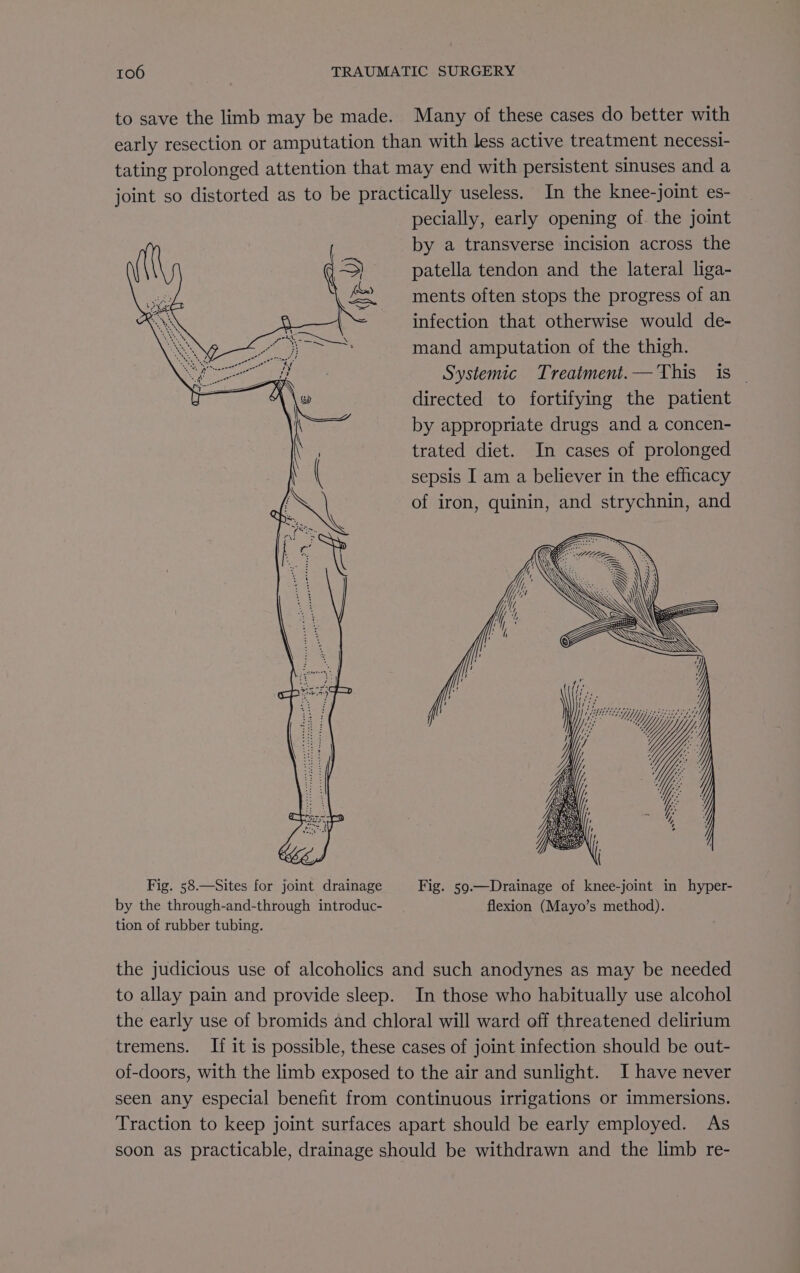 to save the limb may be made. Many of these cases do better with early resection or amputation than with less active treatment necessi- tating prolonged attention that may end with persistent sinuses and a joint so distorted as to be practically useless. In the knee-joint es- pecially, early opening of. the joint by a transverse Incision across the = patella tendon and the lateral liga- als See ments often stops the progress of an SN a = infection that otherwise would de- S s mand amputation of the thigh. Systemic Treatment.— This is | directed to fortifying the patient by appropriate drugs and a concen- trated diet. In cases of prolonged sepsis I am a believer in the efficacy of iron, quinin, and strychnin, and / y i 4 f BROOD AR Sree Sah ear Mi) TIRE R PRED H//,), 7, “A “ (40 a f 4 oe x | Yj, en 5 Fig. 58.—Sites for joint drainage Fig. 59.—Drainage of knee-joint in hyper- by the through-and-through introduc- flexion (Mayo’s method). tion of rubber tubing. the judicious use of alcoholics and such anodynes as may be needed to allay pain and provide sleep. In those who habitually use alcohol the early use of bromids and chloral will ward off threatened delirium tremens. [If it is possible, these cases of joint infection should be out- of-doors, with the limb exposed to the air and sunlight. I have never seen any especial benefit from continuous irrigations or immersions. Traction to keep joint surfaces apart should be early employed. As soon as practicable, drainage should be withdrawn and the limb re-