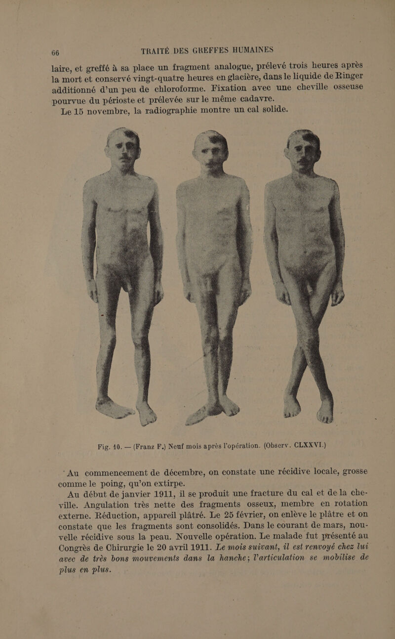 laire, et greffé à sa place un fragment analogue, prélevé trois heures après la mort et conservé vingt-quatre heures en glacière, dans le liquide de Ringer additionné d’un peu de chloroforme. Fixation avec une cheville osseuse pourvue du périoste et prélevée sur le même cadavre. Le 15 novembre, la radiographie montre un cal solide. Au commencement de décembre, on constate une récidive locale, grosse comme le poing, qu’on extirpe. | Au début de janvier 1911, il se produit une fracture du cal et de la che- ville. Angulation très nette des fragments osseux, membre en rotation externe. Réduction, appareil plâtré. Le 25 février, on enlève le plâtre et on constate que les fragments sont consolidés. Dans le courant de mars, nou- velle récidive sous la peau. Nouvelle opération. Le malade fut présenté au Congrès de Chirurgie le 20 avril 1911. Le mois suivant, il est renvoyé chez lui avec de très bons mouvements dans la hanche; l'articulation se mobilise de plus en plus.