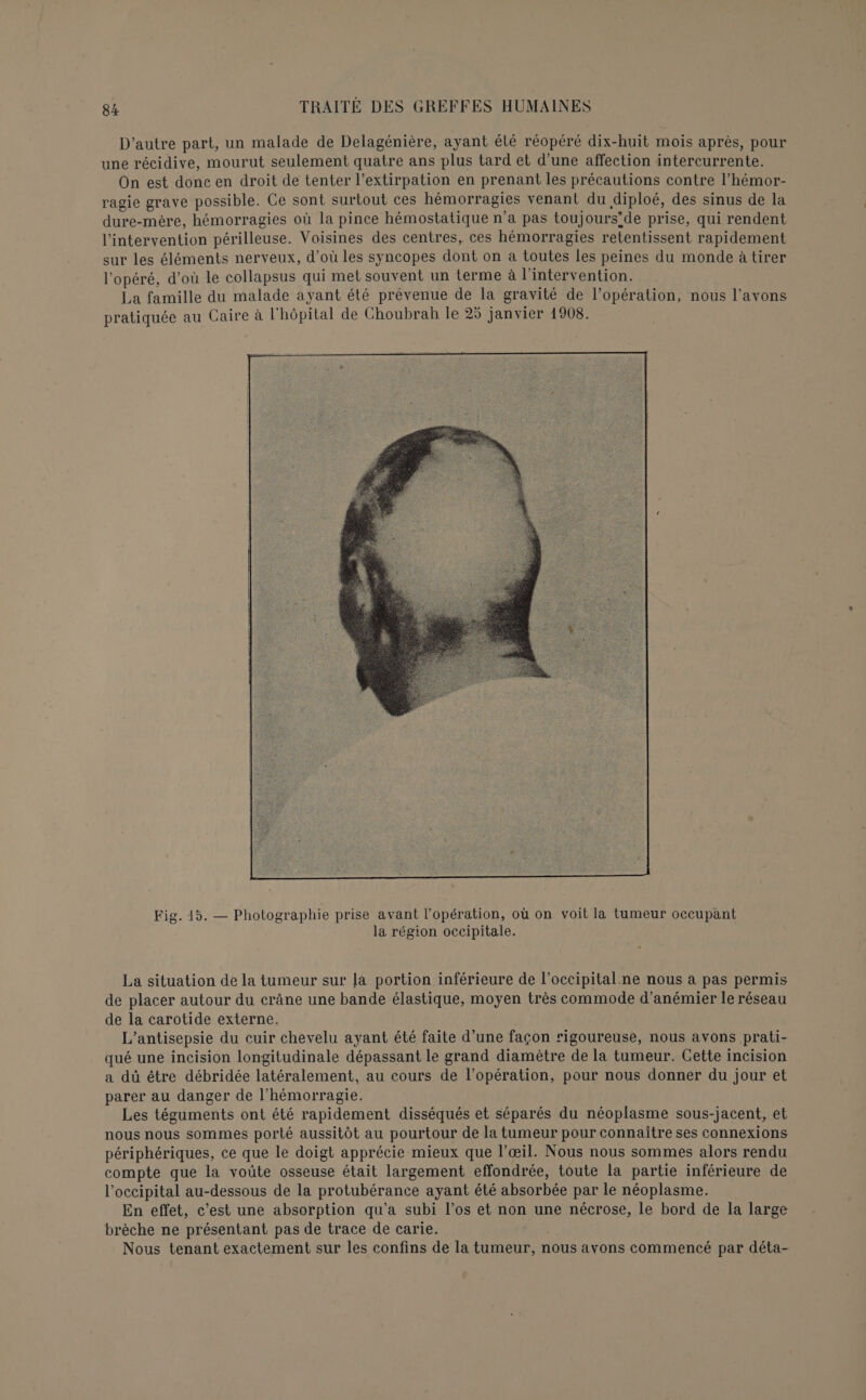 D'autre part, un malade de Delagénière, ayant élé réopéré dix-huit mois après, pour une récidive, mourut seulement quatre ans plus tard et d’une affection intercurrente. On est donc en droit de tenter l’extirpation en prenant les précautions contre l’hémor- ragie grave possible. Ce sont surtout ces hémorragies venant du diploé, des sinus de la dure-mère, hémorragies où la pince hémostatique n’a pas toujours’de prise, qui rendent l'intervention périlleuse. Voisines des centres, ces hémorragies retentissent rapidement sur les éléments nerveux, d’où les syncopes dont on a toutes les peines du monde à tirer l'opéré, d’où le collapsus qui met souvent un terme à l'intervention. La famille du malade ayant été prévenue de la gravité de l’opération, nous l’avons pratiquée au Caire à l'hôpital de Choubrah le 25 janvier 1908. Fig. 15. — Photographie prise avant l'opération, où on voit la tumeur occupant la région occipitale. La situation de la tumeur sur [a portion inférieure de l’occipital ne nous à pas permis de placer autour du crâne une bande élastique, moyen très commode d’anémier le réseau de la carotide externe. L’antisepsie du cuir chevelu ayant été faite d’une façon #igoureuse, nous avons prati- qué une incision longitudinale dépassant le grand diamètre de la tumeur. Cette incision a dü être débridée latéralement, au cours de l’opération, pour nous donner du jour et parer au danger de l’hémorragie. Les téguments ont été rapidement disséqués et séparés du néoplasme sous-jacent, et nous nous sommes porté aussitôt au pourtour de la tumeur pour connaitre ses connexions périphériques, ce que le doigt apprécie mieux que l’œil. Nous nous sommes alors rendu compte que la voûte osseuse était largement effondrée, toute la partie inférieure de l’occipital au-dessous de la protubérance ayant été absorbée par le néoplasme. En effet, c'est une absorption qu'a subi l’os et non une nécrose, le bord de la large brèche ne présentant pas de trace de carie. Nous tenant exactement sur les confins de la tumeur, nous avons commencé par déta-