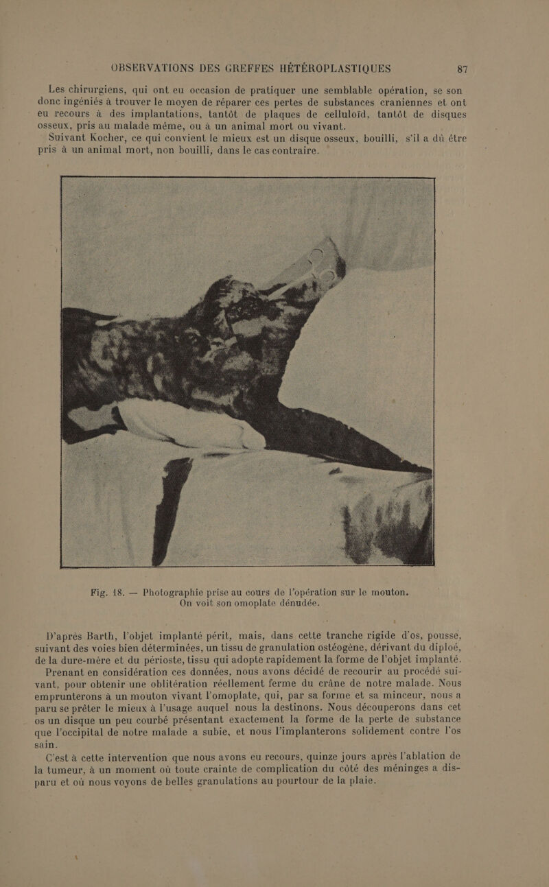 Les chirurgiens, qui ont eu occasion de pratiquer une semblable opération, se son donc ingéniés à trouver le moyen de réparer ces pertes de substances craniennes et ont eu recours à des implantations, tantôt de plaques de celluloïd, tantôt de disques osseux, pris au malade même, ou à un animal mort ou vivant. Suivant Kocher, ce qui convient le mieux est un disque osseux, bouilli, s’il a dû être pris à un animal mort, non bouilli, dans le cas contraire. î D’après Barth, l’objet implanté périt, mais, dans cette tranche rigide d'os, pousse, suivant des voies bien déterminées, un tissu de granulation ostéogène, dérivant du diploé, de la dure-mère et du périoste, tissu qui adopte rapidement la forme de l’objet implanté. Prenant en considération ces données, nous avons décidé de recourir au procédé sui- vant, pour obtenir une oblitération réellement ferme du crâne de notre malade. Nous emprunterons à un mouton vivant l’omoplate, qui, par sa forme et sa minceur, nous a paru se prêter le mieux à l'usage auquel nous la destinons. Nous découperons dans cet os un disque un peu courbé présentant exactement la forme de la perte de substance que l’occipital de notre malade a subie, et nous l’implanterons solidement contre l'os sain. C’est à cette intervention que nous avons eu recours, quinze jours après l’ablation de la tumeur, à un moment où toute crainte de complication du côté des méninges a dis- paru et où nous voyons de belles granulations au pourtour de la plaie.