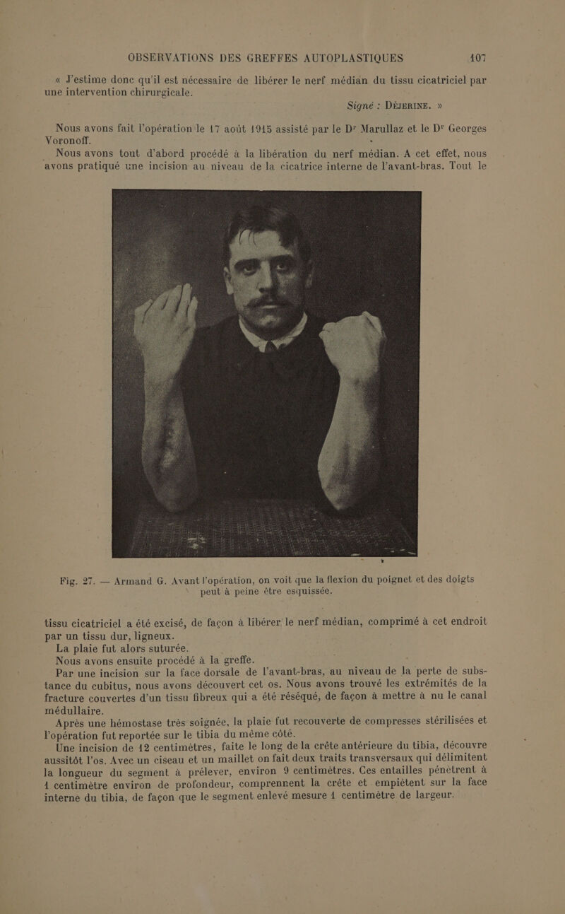 « J estime donc qu'il est nécessaire de libérer le nerf médian du tissu cicatriciel par une intervention chirurgicale. Signé : DÉJERINE. » Nous avons fait l’opération le 17 août 19145 assisté par le D' Marullaz et le D' Georges Voronoff. à . Nous avons tout d’abord procédé à la libération du nerf médian. À cet effet, nous avons pratiqué une incision au niveau de la cicatrice interne de l’avant-bras. Tout le Fig. 27. — Armand G. Avant l'opération, on voit que la flexion du poignet et des doigts peut à peine être esquissée. tissu cicatriciel a été excisé, de façon à libérer le nerf médian, comprimé à cet endroit par un tissu dur, ligneux. La plaie fut alors suturée. Nous avons ensuite procédé à la greffe. Par une incision sur la face dorsale de l’avant-bras, au niveau de la perte de subs- tance du cubitus, nous avons découvert cet os. Nous avons trouvé les extrémités de la fracture couvertes d’un tissu fibreux qui a été réséqué, de façon à mettre à nu le canal médullaire. Après une hémostase très soignée, la plaie fut recouverte de compresses stérilisées et l'opération fut reportée sur le tibia du même côté. Une incision de 12 centimètres, faite le long de la crête antérieure du tibia, découvre aussitôt l'os. Avec un ciseau et un maillet on fait deux traits transversaux qui délimitent la longueur du segment à prélever, environ 9 centimètres. Ces entailles pénétrent à 1 centimètre environ de profondeur, comprennent la crête et empiètent sur la face interne du tibia, de façon que le segment enlevé mesure 1 centimètre de largeur.