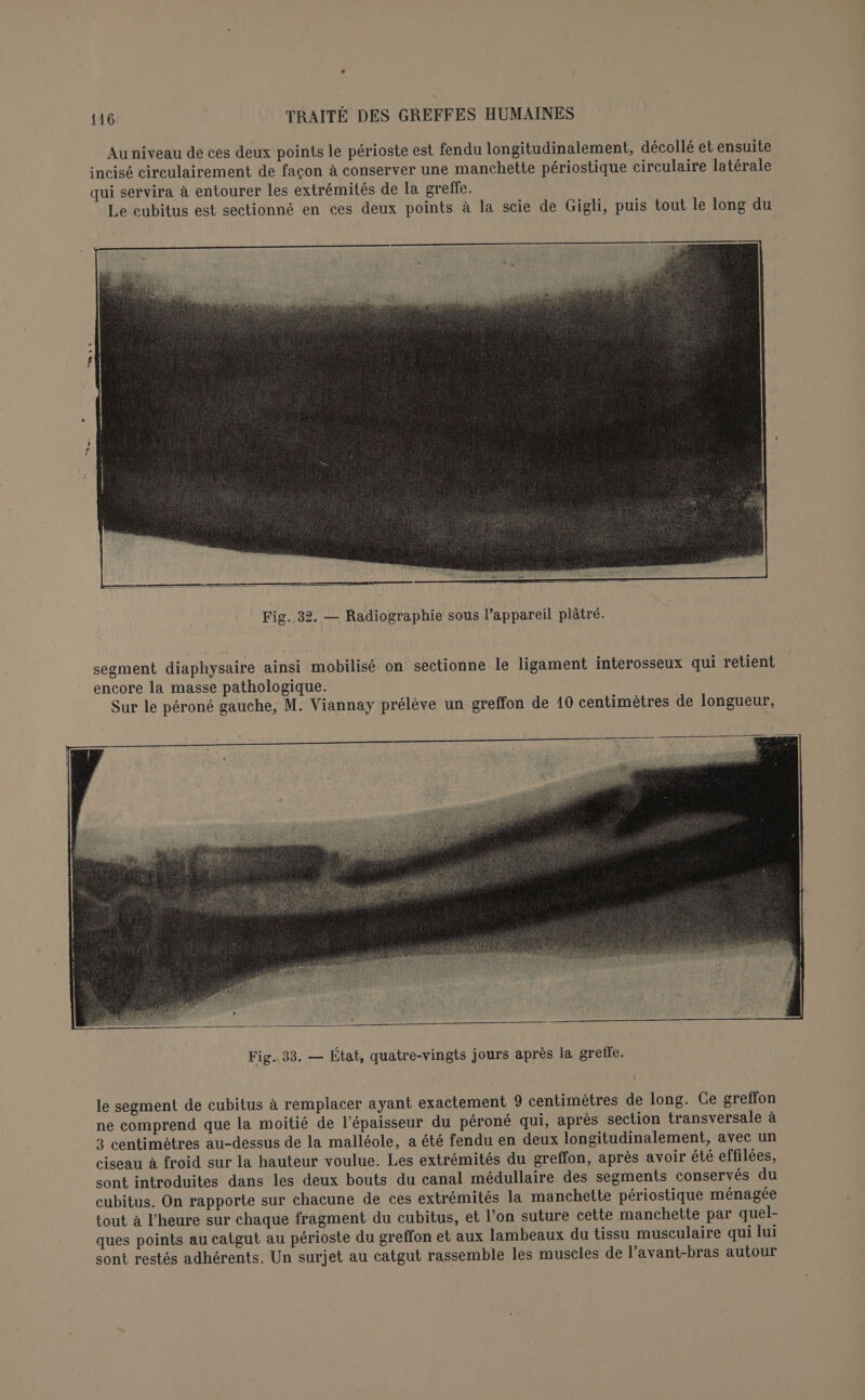 Au niveau de ces deux points le périoste est fendu longitudinalement, décollé et ensuite incisé circulairement de facon à conserver une manchette périostique circulaire latérale qui servira à entourer les extrémités de la greffe. Le cubitus est sectionné en ces deux points à la scie de Gigli, puis tout le long du segment diaphysaire ainsi mobilisé on sectionne le ligament interosseux qui retient encore la masse pathologique. Sur le péroné gauche, M. Viannay prélève un greffon de 10 centimètres de longueur, le segment de cubitus à remplacer ayant exactement 9 centimètres de long. Ge greffon ne comprend que la moitié de l'épaisseur du péroné qui, après section transversale à 3 centimètres au-dessus de la malléole, a été fendu en deux longitudinalement, avec un ciseau à froid sur la hauteur voulue. Les extrémités du greffon, après avoir été effilées, sont introduites dans les deux bouts du canal médullaire des segments conservés du cubitus. On rapporte sur chacune de ces extrémités la manchette périostique ménagée tout à l’heure sur chaque fragment du eubitus, et l’on suture cette manchette par quel- ques points au catgut au périoste du greffon et aux lambeaux du tissu musculaire qui lui sont restés adhérents. Un surjet au catgut rassemble les muscles de l'avant-bras autour