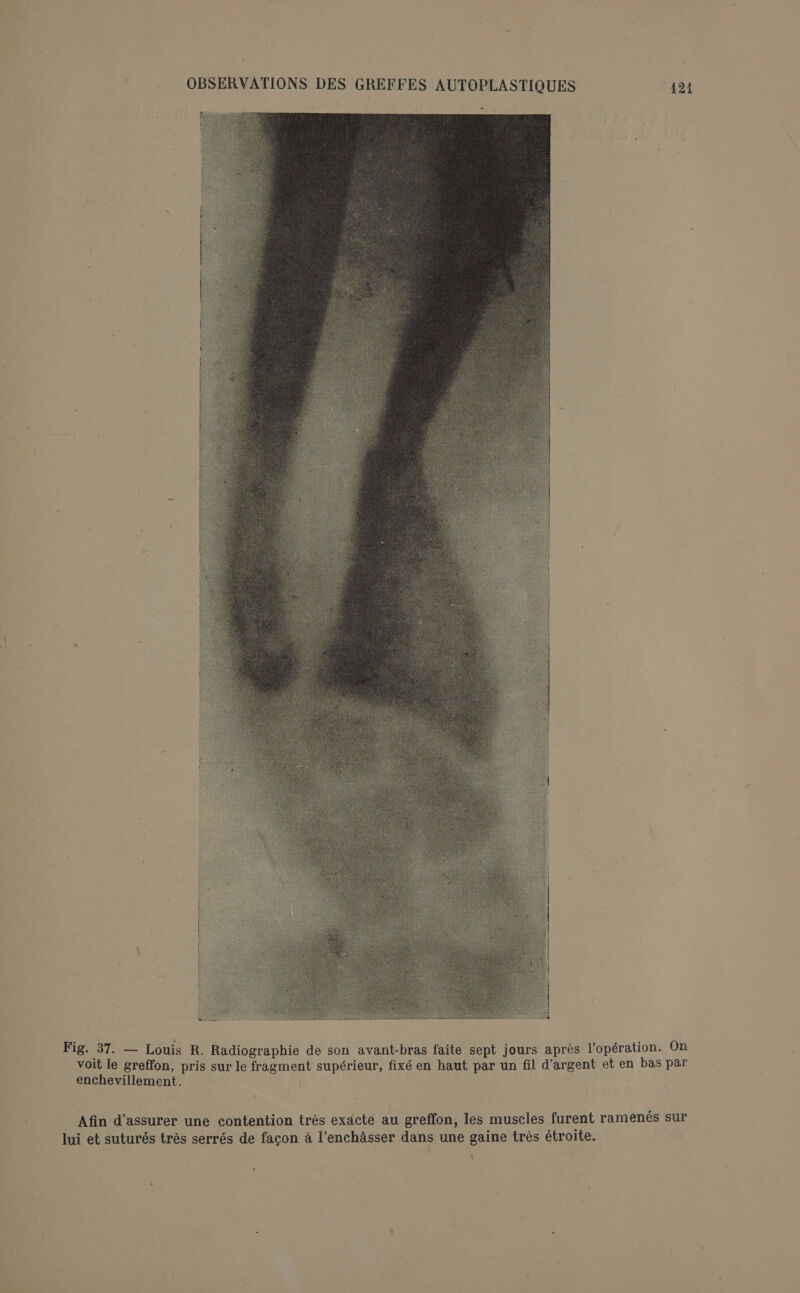 Fig. 37. — Louis R. Radiographie de son avant-bras faite sept jours après l'opération. On voit le greffon, pris sur le fragment supérieur, fixé en haut par un fil d'argent et en bas par enchevillement. Afin d'assurer une contention très exacte au greffon, les muscles furent ramenés sur lui et suturés très serrés de façon à l’enchässer dans une gaine très étroite.