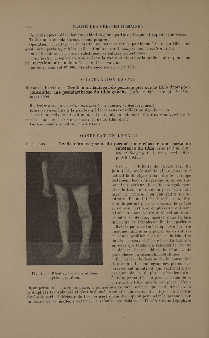 Un mois après : débridement, ablation d’une partie du fragment supérieur nécrosé. Trois mois: pseudarthrose, aucun progrès. Opération : curettage de la cavité; on détache sur la partie supérieure du tibia une greffe ostéo-périostique libre de 5 centimètres sur 2, comprenant la créte du tibia. On la fixe dans la perte de substance par sutures périostiques. Consolidation complète en trois mois ; à la radio, contours de la greffe confus, jambe un peu rétrécie au niveau de la fracture, léger valgus. Raccourcissement 0,005, marche encore un peu pénible. OBSERVATION LXX VII BrADE (de Breslau). — Greffe d’un lambeau de périoste pris sur le tibia droit pour consolider une pseudarthrose du tibia gauche. (Beitr. z. klin. chir. (J. de chir., mars 1909.) H., treize ans, ostéomyélite ancienne tibia gauche, évidée largement. Fracture secondaire à la partie supérieure sans consolidation depuis un an. Opération : avivement, suture au fil d'argent, on entoure le foyer avec un lambeau de périoste, sans os, pris sur la face interne du tibia droit. Cal volumineux et solide en deux mois. OBSERVATION LXXVIIIT C.-J. Bon. — Greffe d'un segment de péroné pour réparer une perte de &amp; substance du tibia. (The British Jour- nal of Surgery t. [, n°4, avril 1914, p. 610 à 624.) Cas I. — Fillette de quatre ans. En juin 1904, ostéomyélite aiguë grave qui détruit la diaphyse tibiale droite et frappe fortement les cartilages épiphysaires, sur- tout le supérieur. Il se forme également dans le tiers inférieur du péroné un petit foyer de nécrose d’où l’on retire un sé- questre. En mai 1905, intervention. Sec- tion du péroné juste en dessous de sa tête et de son cartilage épiphysaire qui sont laissés en place. L’extrémité sectionnée est refoulée en dedans, insérée dans la face inférieure de l’épiphyse tibiale supérieure et fixée là par un fil métallique. On éprouve quelques difficultés à placer les os suturés en bonne position à cause de la friabilité du tissu osseux et à cause de l’action des muscles qui tendent à ramener le péroné en dehors. On est obligé de réintervenir pour placer un second fil métallique. En l’espace de deux mois, la consolida- tion se fait. Les radiographies prises suc- cessivement montrent que l'extrémité su- Fig. 41. — Résultat, trois ans et demi périeure de la diaphyse péronière s’est apres l'opération. élargie, prenant à peu près la forme de la portion du tibia qu’elle remplace, L’épi- physe péronière, laissée en place, a poussé une colonne osseuse qui s'est dirigée vers la diaphyse transplantée et s’est fusionnée avec elle. En raison d'un foyer de nécrose situé à la partie inférieure de l’os, ce n’est qu’en 1907 qu’on peut scier le péroné juste au-dessus de la malléole externe, le refouler en dedans et l'insérer dans l’épiphyse