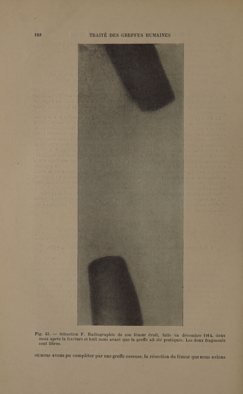 : s SA. d LE JF 42 . ; f IE GA 2 © &amp;. 4 ‘ j d : i \ ‘ è \ 2 : F , f a “| j j ’ y 7 :L 4 n Ù Le at . : . 0) “ ’ F . 4 : * L ÿ » &amp; . « . ? . + 3 \ st à‘ s 7% 2545208 rt x a ; ‘ Fig. 43. — Sébastien F. Radiographie de son fémur droit, faite en décembre 1914, deux mois après la fracture et huit mois avant que la greffe ait été pratiquée. Les deux fragments sont libres. oùnous avons pu compléter par une greffe osseuse, la résection du fémur que nous avions