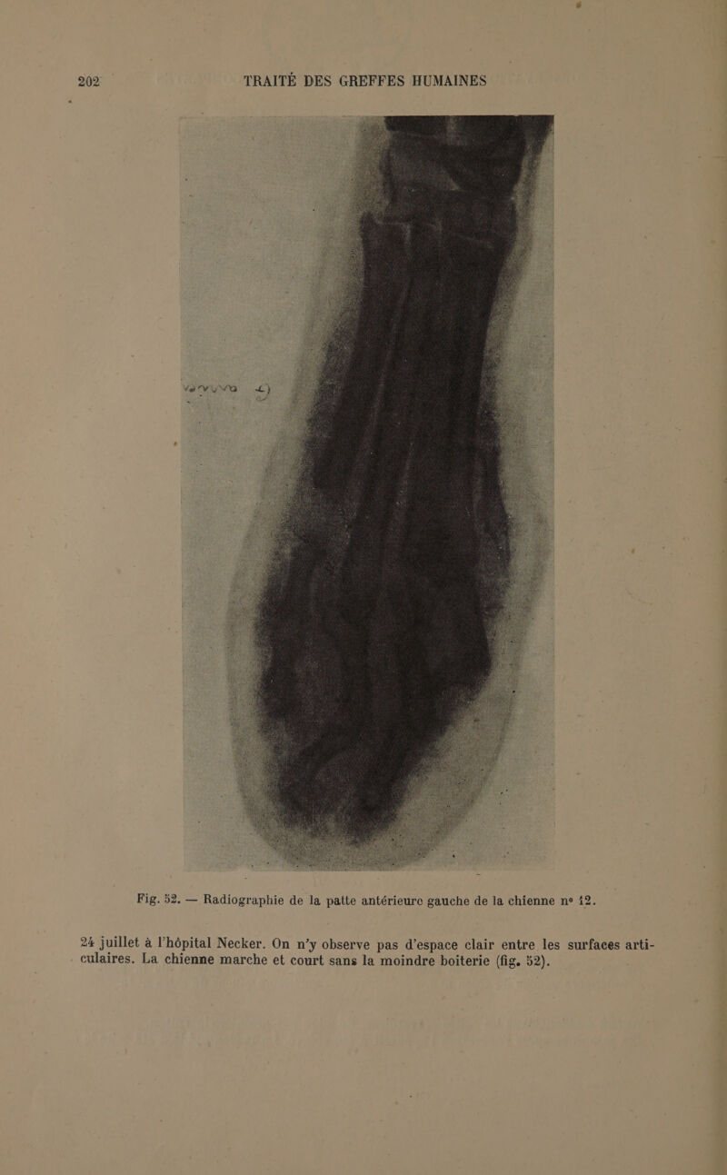 Fig. 52. — Radiographie de la patte antérieure gauche de la chienne ne 12. 24 juillet à l'hôpital Necker. On n’y observe pas d’espace clair entre les surfaces arti- culaires. La chienne marche et court sans la moindre boiterie (fig. 52).